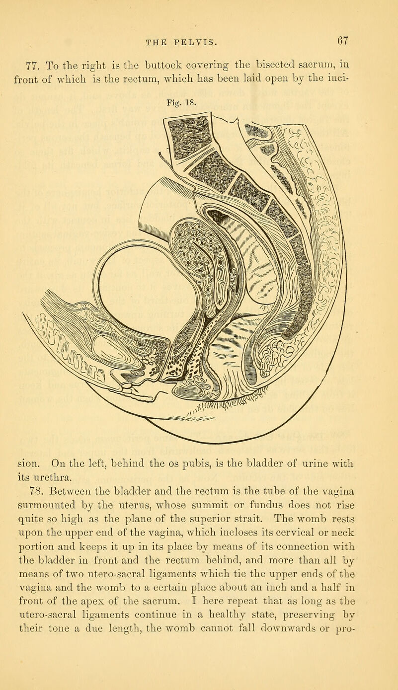 77. To the right is the buttock covering the bisected sacrum, in front of which is the rectum, which has been laid open by the inci- Fig. 18. sion. On the left, behind the os pubis, is the bladder of urine with its urethra. 78. Between the bladder and the rectum is the tube of the vagina surmounted by the uterus, whose summit or fundus does not rise quite so high as the plane of the superior strait. The womb rests upon the upper end of the vagina, which incloses its cervical or neck portion and keeps it up in its place by means of its connection with the bladder in front and the rectum behind, and more than all by means of two utero-sacral ligaments which tie the upper ends of the vagina and the womb to a certain place about an inch and a half in front of the apex of the sacrum. I here repeat that as long as the utero-sacral ligaments continue in a healthy state, preserving by their tone a due length, the womb cannot fall downwards or pro-