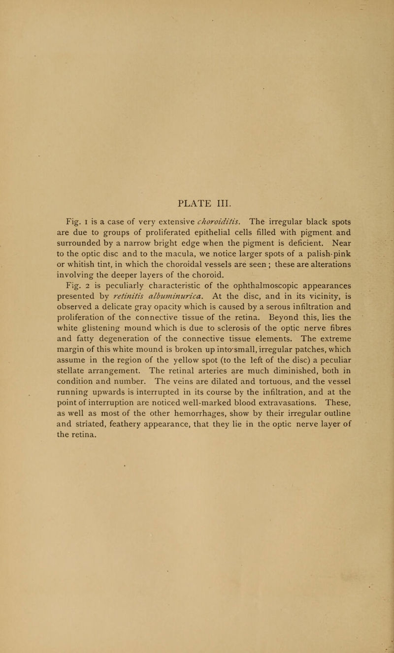 Fig. i is a case of very extensive choroiditis. The irregular black spots are due to groups of proliferated epithelial cells filled with pigment and surrounded by a narrow bright edge when the pigment is deficient. Near to the optic disc and to the macula, we notice larger spots of a palish-pink or whitish tint, in which the choroidal vessels are seen ; these are alterations involving the deeper layers of the choroid. Fig. 2 is peculiarly characteristic of the ophthalmoscopic appearances presented by retinitis albuminurica. At the disc, and in its vicinity, is observed a delicate gray opacity which is caused by a serous infiltration and proliferation of the connective tissue of the retina. Beyond this, lies the white glistening mound which is due to sclerosis of the optic nerve fibres and fatty degeneration of the connective tissue elements. The extreme margin of this white mound is broken up into'small, irregular patches, which assume in the region of the yellow spot (to the left of the disc) a peculiar stellate arrangement. The retinal arteries are much diminished, both in condition and number. The veins are dilated and tortuous, and the vessel running upwards is interrupted in its course by the infiltration, and at the point of interruption are noticed well-marked blood extravasations. These, as well as most of the other hemorrhages, show by their irregular outline and striated, feathery appearance, that they lie in the optic nerve layer of the retina.