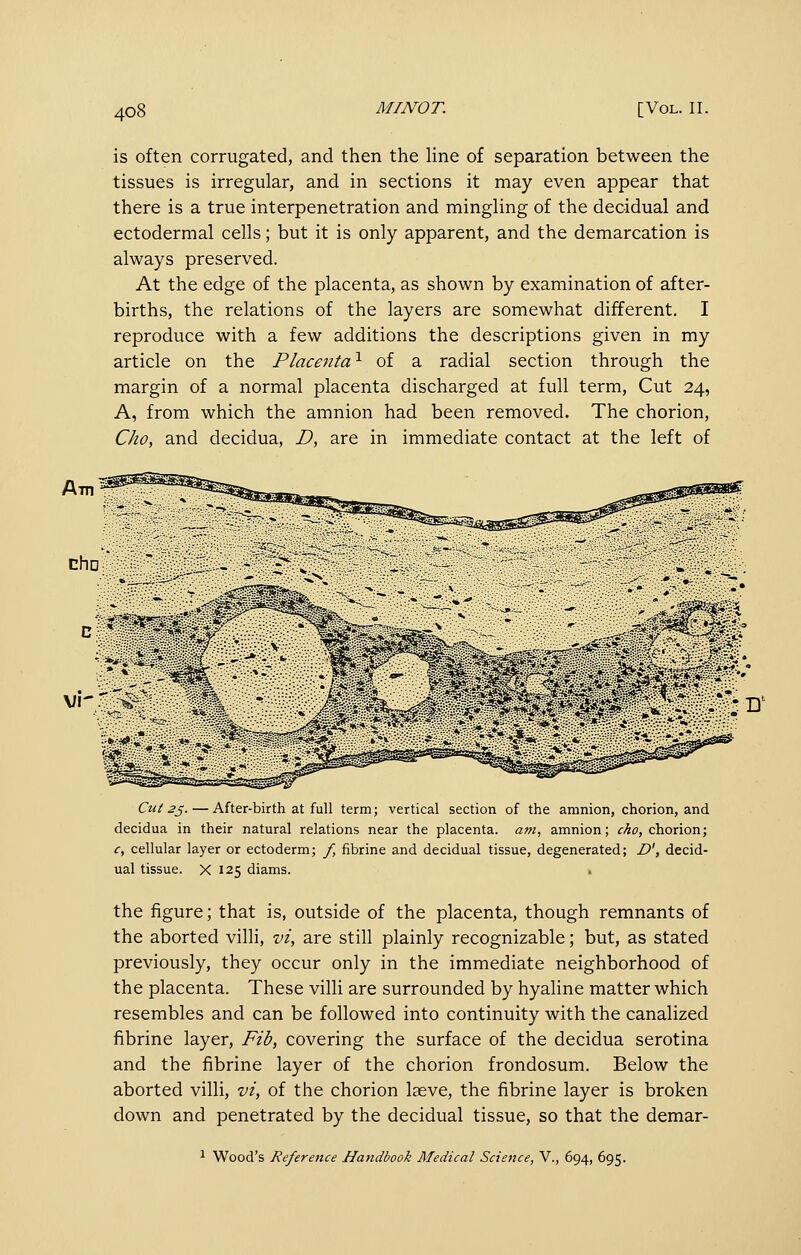 is often corrugated, and then the line of separation between the tissues is irregular, and in sections it may even appear that there is a true interpenetration and mingling of the decidual and ectodermal cells; but it is only apparent, and the demarcation is always preserved. At the edge of the placenta, as shown by examination of after- births, the relations of the layers are somewhat different. I reproduce with a few additions the descriptions given in my article on the Placenta'^ of a radial section through the margin of a normal placenta discharged at full term. Cut 24, A, from which the amnion had been removed. The chorion, Cho, and decidua, D, are in immediate contact at the left of Am Cut 2^.—After-birth at full term; vertical section of the amnion, chorion, and decidua in their natural relations near the placenta, am, amnion; cho, chorion; c, cellular layer or ectoderm; f, fibrine and decidual tissue, degenerated; D', decid- ual tissue. X 125 diams. the figure; that is, outside of the placenta, though remnants of the aborted villi, vi, are still plainly recognizable; but, as stated previously, they occur only in the immediate neighborhood of the placenta. These villi are surrounded by hyaline matter which resembles and can be followed into continuity with the canalized fibrine layer. Fib, covering the surface of the decidua serotina and the fibrine layer of the chorion frondosum. Below the aborted villi, vi, of the chorion laeve, the fibrine layer is broken down and penetrated by the decidual tissue, so that the demar- ^ Wood's Reference Handbook Medical Science, V., 694, 695.