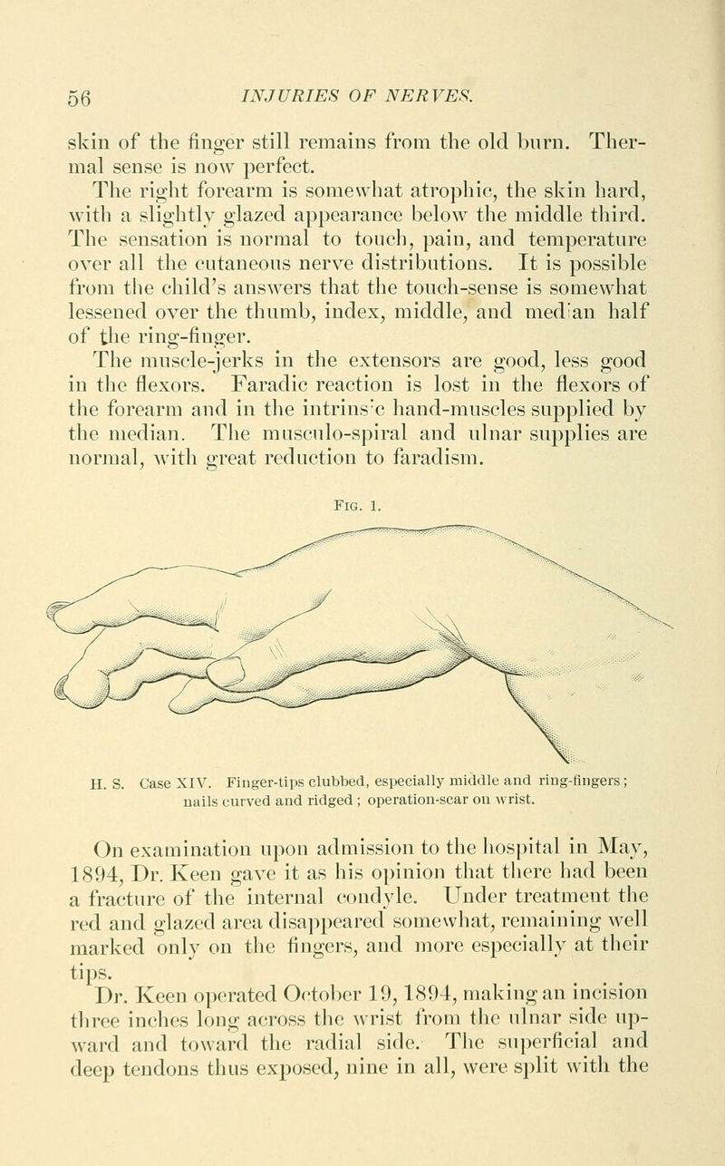 skin of the fino;er still remains from the old burn. Ther- mal sense is now perfect. The right forearm is somewhat atrophic, the skin hard, with a slightly glazed appearance below the middle third. The sensation is normal to touch, pain, and temperature over all the cutaneous nerve distributions. It is possible from the child's answers that the touch-sense is somewhat lessened over the thumb, index, middle, and median half of the ring-finger. The muscle-jerks in the extensors are good, less good in the flexors. Faradic reaction is lost in the flexors of the forearm and in the intrins'c hand-muscles supplied by the median. The musculo-spiral and ulnar supplies are normal, Avith great reduction to faradism. Fig. 1. H. S. Case XIV. Finger-tips clubbed, especially middle and ring-fingers; nails curved and ridged ; operation-scar on wrist. On examination upon admission to the hospital in May, 1894, Dr. Keen gave it as his opinion that there had been a fracture of the internal condyle. Under treatment the red and glazed area disaj^peared somewhat, remaining well marked only on the fingers, and more especially at their tips. Dr. Keen operated October 19,1894, making an incision three inches long across the wrist from tlic ulnar side up- ward and toward the radial side. The superficial and deep tendons thus exposed, nine in all, were split with the