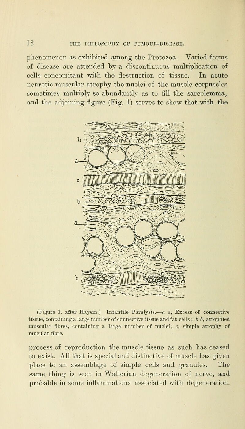 phenomenon as exhibited among the Protozoa. Varied forms of disease are attended by a discontinuous multiplication of cells concomitant with the destruction of tissue. In acute neurotic muscular atrophy the nuclei of the muscle corpuscles sometimes multiply so abundantl}^ as to fill the sarcolemma, and the adjoining figure (Fig. 1) serves to show that with the b ^^g?flSm^ni!i« (Figure 1. after Hayem.) Infantile Paralysis.—a a, Excess of connective tissue, containing a large number of connective tissue and fat cells ; b b, atrophied muscular fibres, containing a large number of nuclei; c, simple atrophy of mucular fibre. process of reproduction the muscle tissue as such has ceased to exist. All that is special and distinctive of muscle has given place to an assemblage of simple cells and granules. The same thing is seen in Wallerian degeneration of nerve, and probable in some inflammations associated with degeneration.