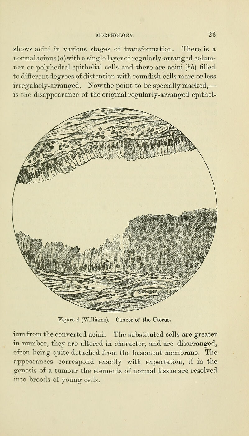 sliows acini in various stages of transformation There is a normal acinus (a) witli a single layer of regularly-arranged colum- nar or polyhedral epithelial cells and there are acini {bh) filled to different degrees of distention with roundish cells more or less irregularly-arranged. Nowthe point to be specially marked,— is the disappearance of the original regularly-arranged epithel- Figure 4 (Williams). Cancer of the Uterus. ium from the converted acini. The substituted cells are greater in number_, they are altered in character^ and are disarranged, often being* quite detached from the basement membrane. The appearances correspond exactly with expectation, if in the genesis of a tumour the elements of normal tissue are resolved into broods of young cells.