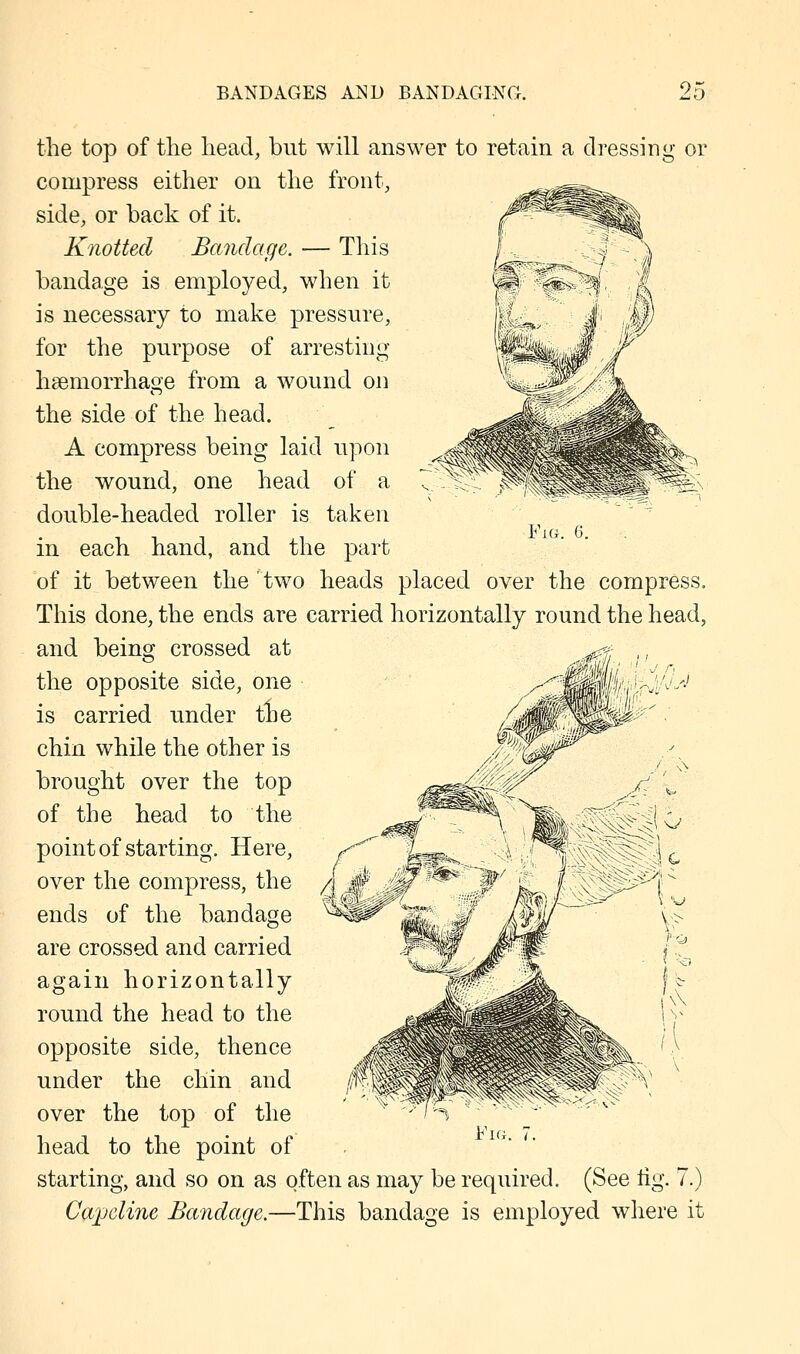 Fig. 6. the top of the head, but will answer to retain a dressing or compress either on the front, side, or back of it. Knotted Bandage. — This bandage is employed, when it is necessary to make pressure, for the purpose of arresting haemorrhage from a wound on the side of the head. A compress being laid upon the wound, one head of a double-headed roller is taken in each hand, and the part of it between the two heads placed over the compress. This done, the ends are carried horizontally round the head, and being crossed at the opposite side, one is carried under the chin while the other is brought over the top of the head to the point of starting. Here, over the compress, the ends of the bandage are crossed and carried again horizontally round the head to the opposite side, thence under the chin and over the top of the head to the point of Caroline Bandage.—This bandage is employed where it Fig.