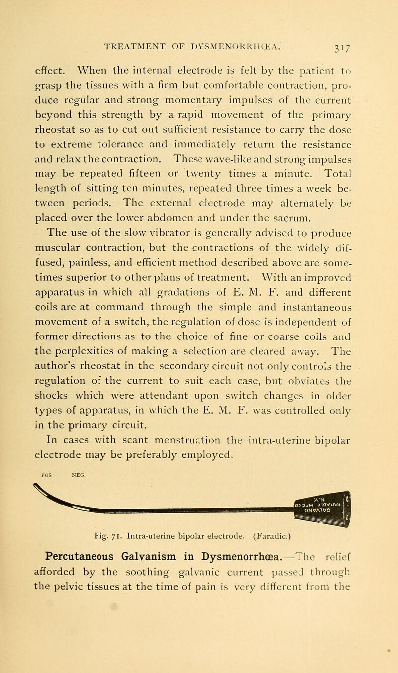 effect. When the internal electrode is felt by the patient to grasp the tissues with a firm but comfortable contraction, pro- duce regular and strong momentary impulses of the current beyond this strength by a rapid movement of the primary rheostat so as to cut out sufificient resistance to carry the dose to extreme tolerance and immediately return the resistance and relax the contraction. These wave-like and strong impulses may be repeated fifteen or twenty times a minute. Total length of sitting ten minutes, repeated three times a week be- tween periods. The external electrode may alternately be placed over the lower abdomen and under the sacrum. The use of the slow vibrator is generally advised to produce muscular contraction, but the contractions of the widely dif- fused, painless, and efficient method described above are some- times superior to other plans of treatment. With an improved apparatus in which all gradations of E. M. F. and different coils are at command through the simple and instantaneous movement of a switch, the regulation of dose is independent of former directions as to the choice of fine or coarse coils and the perplexities of making a selection are cleared away. The author's rheostat in the secondary circuit not only controls the regulation of the current to suit each case, but obviates the shocks which were attendant upon switch changes in older types of apparatus, in which the E. M. F. was controlled only in the primary circuit. In cases with scant menstruation the intra-uterine bipolar electrode may be preferably employed. Fig. 71. Intra-uterine bipolar electrode. (Faradic.) Percutaneous Galvanism in Dysmenorrhoea.—The relief afforded by the soothing galvanic current passed through the pelvic tissues at the time of pain is very different from the