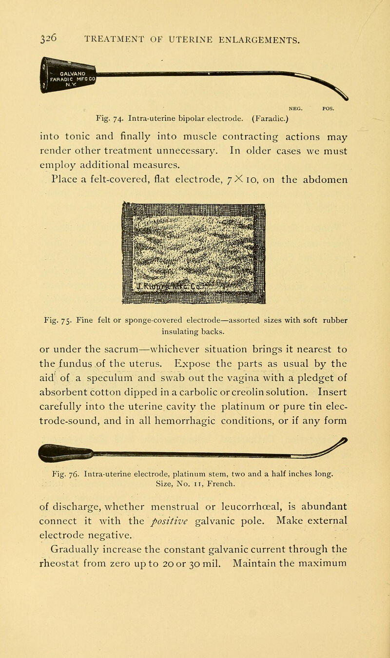 Fig. 74. Intra-uterine bipolar electrode. (Faradic.) into tonic and finally into muscle contracting actions may render other treatment unnecessary. In older cases we must employ additional measures. Place a felt-covered, flat electrode, 7X 10, on the abdomen Fig. 75. Fine felt or sponge-covered electrode—assorted sizes with soft rubber insulating backs. or under the sacrum—whichever situation brings it nearest to the fundus of the uterus. Expose the parts as usual by the aid' of a speculum and swab out the vagina with a pledget of absorbent cotton dipped in a carbolic or creolin solution. Insert carefully into the uterine cavity the platinum or pure tin elec- trode-sound, and in all hemorrhagic conditions, or if any form Fig. 76- Intra-uterine electrode, platinum stem, two and a half inches long. Size, No. II, French. of discharge, whether menstrual or leucorrhoeal, is abundant connect it with the positive galvanic pole. Make external electrode negative. Gradually increase the constant galvanic current through the rheostat from zero up to 20 or 30 mil. Maintain the maximum