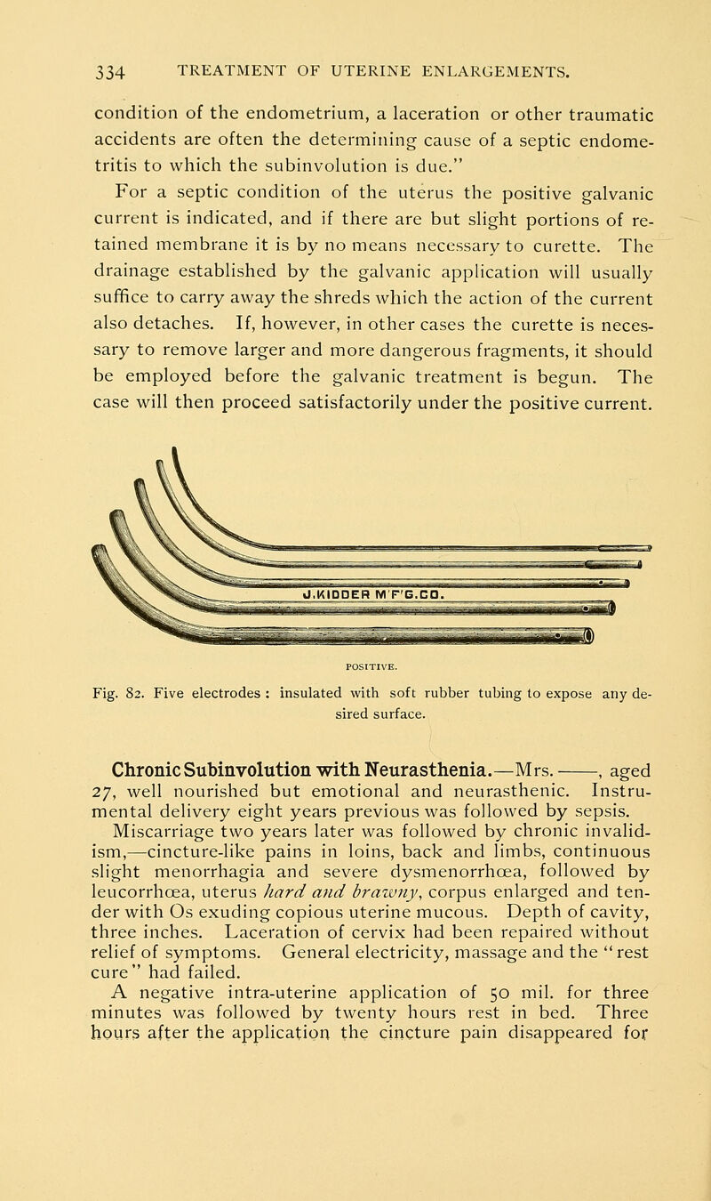 condition of the endometrium, a laceration or other traumatic accidents are often the determining cause of a septic endome- tritis to which the subinvolution is due. For a septic condition of the uterus the positive galvanic current is indicated, and if there are but slight portions of re- tained membrane it is by no means necessary to curette. The drainage established by the galvanic application will usually suffice to carry away the shreds which the action of the current also detaches. If, however, in other cases the curette is neces- sary to remove larger and more dangerous fragments, it should be employed before the galvanic treatment is begun. The case will then proceed satisfactorily under the positive current. KIODER M P'G.Ca. ■WL 1, i-li 1' ■ ■-, iT— ii^U-^^-z::,^:^-■:-!.. ^^ jjj^^^^ n II n.ft.,,1 POSITIVE. Fig. 8 :. Five electrodes : insulated with soft rubber tubing to expose any de- sired surface. Chronic Subinvolution with Neurasthenia.—Mrs. , aged 27, well nourished but emotional and neurasthenic. Instru- mental delivery eight years previous was followed by sepsis. Miscarriage two years later was followed by chronic invalid- ism,—cincture-like pains in loins, back and limbs, continuous slight menorrhagia and severe dysmenorrhoea, followed by leucorrhoea, uterus /lard and brazvny, corpus enlarged and ten- der with Os exuding copious uterine mucous. Depth of cavity, three inches. Laceration of cervix had been repaired without relief of symptoms. General electricity, massage and the  rest cure had failed. A negative intra-uterine application of 50 mil, for three minutes was followed by twenty hours rest in bed. Three hours after the application the cincture pain disappeared for