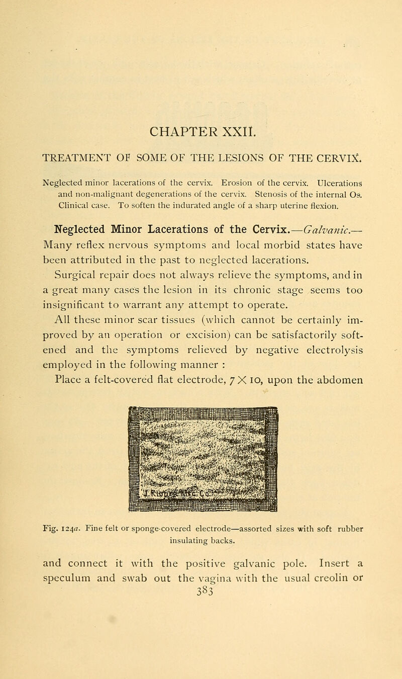 CHAPTER XXII. TREATMENT OF SOME OF THE LESIONS OF THE CERVi:^. Neglected minor lacerations of the cervix. Erosion of the cervix. Ulcerations and non-malignant degenerations of the cervix. Stenosis of the internal Os. Clinical case. To soften the indurated angle of a sharp uterine flexion. Neglected Minor Lacerations of the Cervix.—Galvanic.— Many reflex nervous symptoms and local morbid states have been attributed in the past to neglected lacerations. Surgical repair does not always relieve the symptoms, and in a great many cases the lesion in its chronic stage seems too insignificant to warrant any attempt to operate. All these minor scar tissues (which cannot be certainly im- proved by an operation or excision) can be satisfactorily soft- ened and the symptoms relieved by negative electrolysis employed in the following manner : Place a felt-covered flat electrode, 7 X lO, upon the abdomen Fig. I24«. Fine felt or sponge-covered electrode—assorted sizes with soft rubber insulating backs. and connect it with the positive galvanic pole. Insert a speculum and swab out the vagina with the usual creolin or