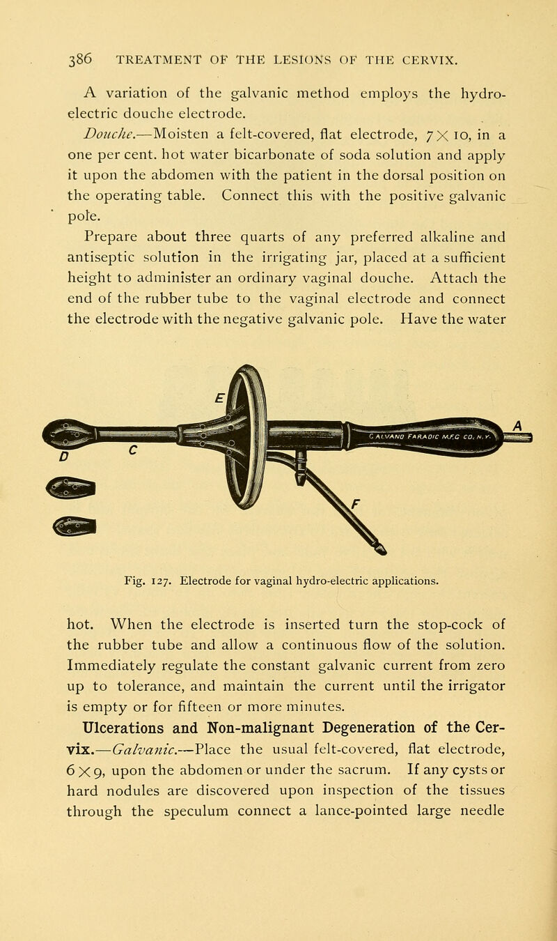 A variation of the galvanic method employs the hydro- electric douche electrode. Douche.—Moisten a felt-covered, flat electrode, 7X 10, in a one per cent, hot water bicarbonate of soda solution and apply it upon the abdomen with the patient in the dorsal position on the operating table. Connect this with the positive galvanic pole. Prepare about three quarts of any preferred alkaline and antiseptic solution in the irrigating jar, placed at a sufificient height to administer an ordinary vaginal douche. Attach the end of the rubber tube to the vaginal electrode and connect the electrode with the negative galvanic pole. Have the water Fig. 127. Electrode for vaginal hydro-electric applications. hot. When the electrode is inserted turn the stop-cock of the rubber tube and allow a continuous flow of the solution. Immediately regulate the constant galvanic current from zero up to tolerance, and maintain the current until the irrigator is empty or for fifteen or more minutes. Ulcerations and Non-malignant Degeneration of the Cer- vix.—Galvanic.—Place the usual felt-covered, flat electrode, 6x9, upon the abdomen or under the sacrum. If any cysts or hard nodules are discovered upon inspection of the tissues through the speculum connect a lance-pointed large needle