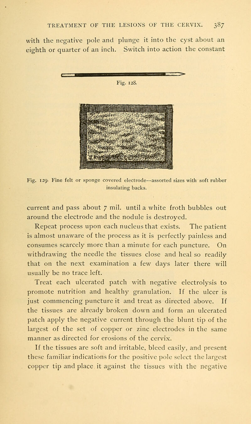 with the negative pole and plunge it into the cyst about an eighth or quarter of an inch. Switch into action the constant Fig. 128. Fig. 129- Fine felt or sponge covered electrode—assorted sizes with soft rubber insulating backs. current and pass about 7 mil. until a white froth bubbles out around the electrode and the nodule is destroyed. Repeat process upon each nucleus that exists. The patient is almost unaware of the process as it is perfectly painless and consumes scarcely more than a minute for each puncture. On withdrawing the needle the tissues close and heal so readily that on the next examination a few days later there will usually be no trace left. Treat each ulcerated patch with negative electrolysis to promote nutrition and healthy granulation. If the ulcer is just commencing puncture it and treat as directed above. If the tissues are already broken down and form an ulcerated patch apply the negative current through the blunt tip of the largest of the set of copper or zinc electrodes in the same manner as directed for erosions of the cervix. If the tissues are soft and irritable, bleed easily, and present these familiar indications for the positive pole select the largest copper tip and place it against the tissues with the negative