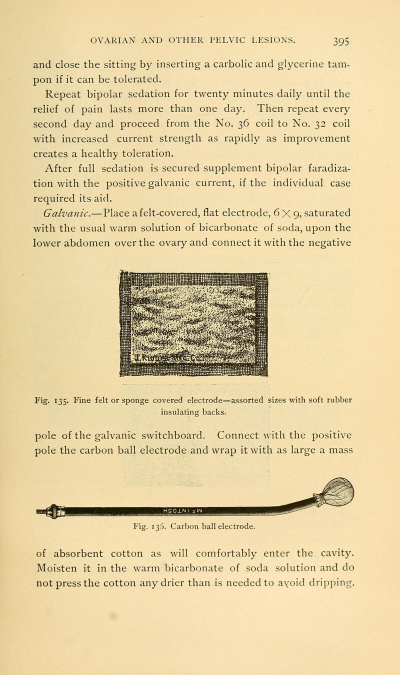 and close the sitting by inserting a carbolic and glycerine tam- pon if it can be tolerated. Repeat bipolar sedation for twenty minutes daily until the relief of pain lasts more than one day. Then repeat every second day and proceed from the No. 36 coil to No. 32 coil with increased current strength as rapidly as improvement creates a healthy toleration. After full sedation is secured supplement bipolar faradiza- tion with the positive galvanic current, if the individual case required its aid. Galvanic.—Place a felt-covered, flat electrode, 6X9, saturated with the usual warm solution of bicarbonate of soda, upon the lower abdomen over the ovary and connect it with the negative Fig. 135. Fine felt or sponge covered electrode—assorted sizes with soft rubber insulating backs. pole of the galvanic switchboard. Connect with the positive pole the carbon ball electrode and wrap it with as large a mass Fig. 136. Carbon ball electrode. of absorbent cotton as will comfortably enter the cavity. Moisten it in the warm bicarbonate of soda solution and do not press the cotton any drier than is needed to avoid dripping.