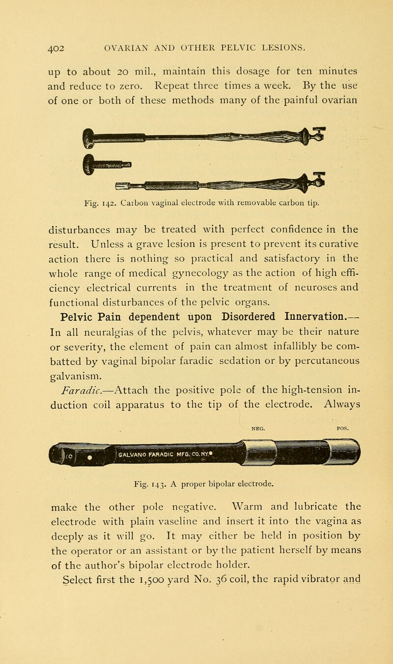 up to about 20 mil., maintain this dosage for ten minutes and reduce to zero. Repeat three times a week. By the use of one or both of these methods many of the painful ovarian Fig. 142. Carbon vaginal electrode with removable carbon tip. disturbances may be treated with perfect confidence in the result. Unless a grave lesion is present to prevent its curative action there is nothing so practical and satisfactory in the whole range of medical gynecology as the action of high effi- ciency electrical currents in the treatment of neuroses and functional disturbances of the pelvic organs. Pelvic Pain dependent upon Disordered Innervation.— In all neuralgias of the pelvis, whatever may be their nature or severity, the element of pain can almost infallibly be com- batted by vaginal bipolar faradic sedation or by percutaneous galvanism. Faradic.—Attach the positive pole of the high-tension in- duction coil apparatus to the tip of the electrode. Always Fig. 143. A proper bipolar electrode. make the other pole negative. Warm and lubricate the electrode with plain vaseline and insert it into the vagina as deeply as it will go. It may either be held in position by the operator or an assistant or by the patient herself by means of the author's bipolar electrode holder. Select first the 1,500 yard No. 36 coil, the rapid vibrator and