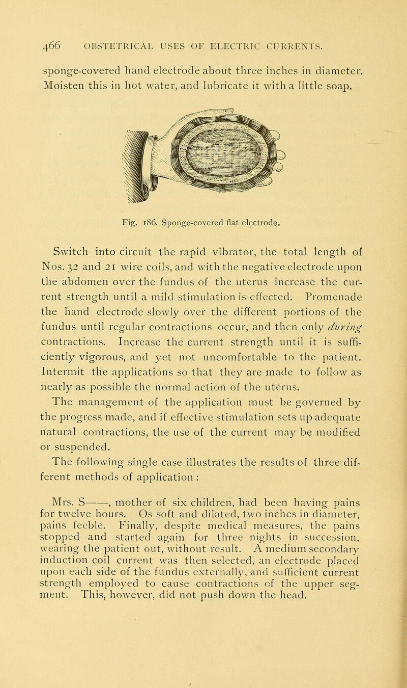 sponge-covered hand electrode about three inches in diameter. Moisten this in hot water, and lubricate it with a little soap. Fig. i86. Sponge-covered flat electrode. Switch into circuit the rapid vibrator, the total length of Nos. 32 and 21 wire coils, and with the negative electrode upon the abdomen over the fundus of the uterus increase the cur- rent strength until a mild stimulation is effected. Promenade the hand electrode slowly over the different portions of the fundus until regular contractions occur, and then only during contractions. Increase the current strength until it is suffi- ciently vigorous, and yet not uncomfortable to the patient. Intermit the applications so that they are made to follow as nearly as possible the normal action of the uterus. The management of the application must be governed by the progress made, and if effective stimulation sets up adequate natural contractions, the use of the current may be modified or suspended. The following single case illustrates the results of three dif- ferent methods of application : Mrs. S , mother of six children, had been having pains for twelve hours. Os soft and dilated, two inches in diameter, pains feeble. Finally, despite medical measures, the pains stopped and started again for three nights in succession, wearing the patient out, without result. A medium secondary induction coil current was then selected, an electrode placed upon each side of the fundus externally, and sufficient current strength employed to cause contractions of the upper seg- ment. This, however, did not push down the head.