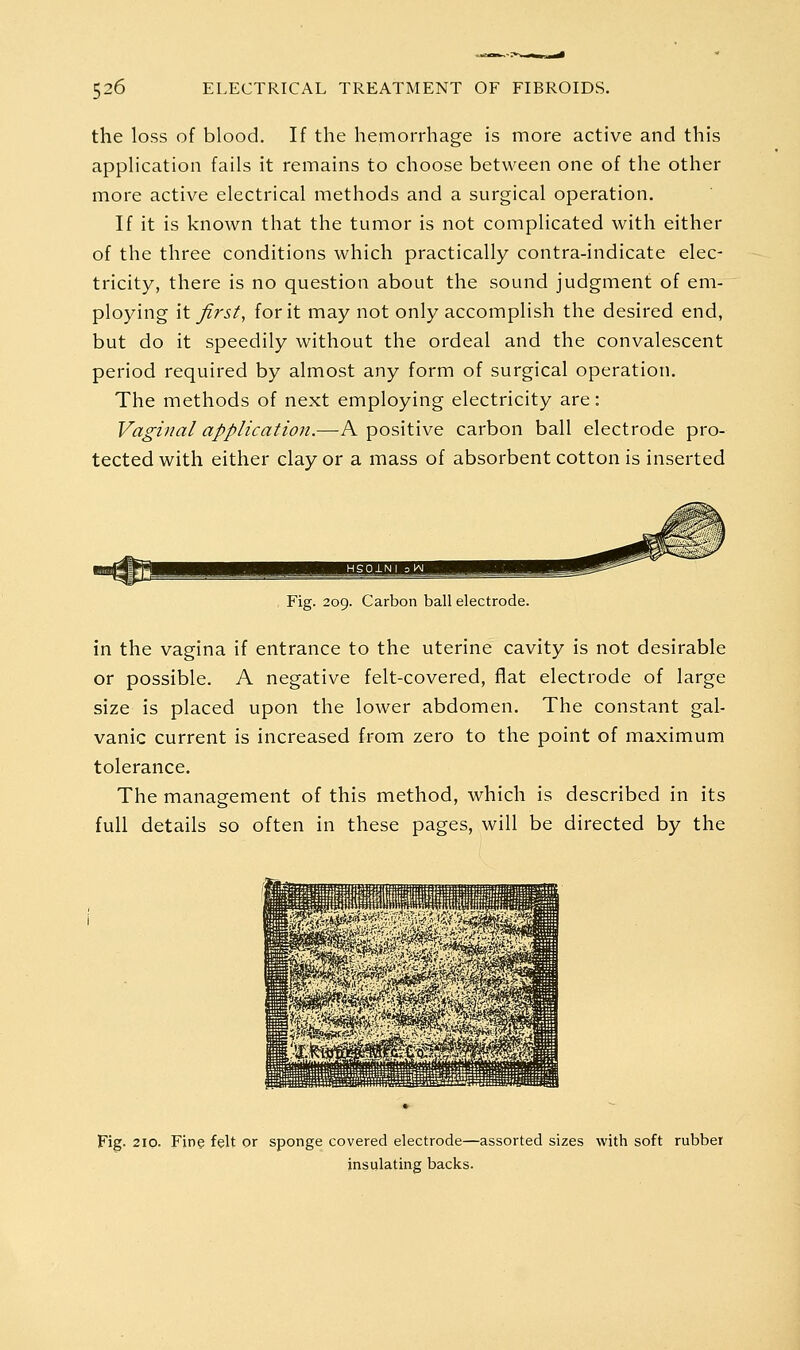 the loss of blood. If the hemorrhage is more active and this application fails it remains to choose between one of the other more active electrical methods and a surgical operation. If it is known that the tumor is not complicated with either of the three conditions which practically contra-indicate elec- tricity, there is no question about the sound judgment of em- ploying it firsts for it may not only accomplish the desired end, but do it speedily without the ordeal and the convalescent period required by almost any form of surgical operation. The methods of next employing electricity are: Vaginal application.—A positive carbon ball electrode pro- tected with either clay or a mass of absorbent cotton is inserted . Fig. 209. Carbon ball electrode. in the vagina if entrance to the uterine cavity is not desirable or possible. A negative felt-covered, flat electrode of large size is placed upon the lower abdomen. The constant gal- vanic current is increased from zero to the point of maximum tolerance. The management of this method, which is described in its full details so often in these pages, will be directed by the Fig. 210. Fine felt or sponge covered electrode—assorted sizes with soft rubber insulating backs.