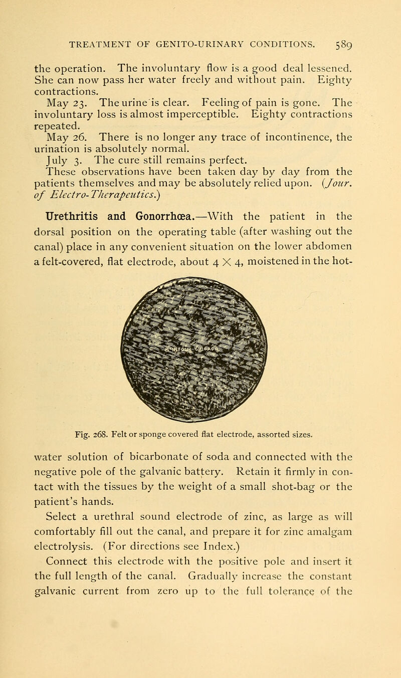 the operation. The involuntary flow is a good deal lessened. She can now pass her water freely and without pain. Eighty contractions. May 23. The urine is clear. Feeling of pain is gone. The involuntary loss is almost imperceptible. Eighty contractions repeated. May 26. There is no longer any trace of incontinence, the urination is absolutely normal. July 3. The cure still remains perfect. These observations have been taken day by day from the patients themselves and may be absolutely relied upon. {Jour, of Electro-Therapetitics.) Urethritis and Gonorrhoea.—With the patient in the dorsal position on the operating table (after washing out the canal) place in any convenient situation on the lower abdomen a felt-covered, flat electrode, about 4X4, moistened in the hot- Fig. 268. Felt or sponge covered flat electrode, assorted sizes. water solution of bicarbonate of soda and connected with the negative pole of the galvanic battery. Retain it firmly in con- tact with the tissues by the weight of a small shot-bag or the patient's hands. Select a urethral sound electrode of zinc, as large as will comfortably fill out the canal, and prepare it for zinc amalgam electrolysis. (For directions see Index.) Connect this electrode with the positive pole and insert it the full length of the canal. Gradually increase the constant galvanic current from zero up to the full tolerance of the