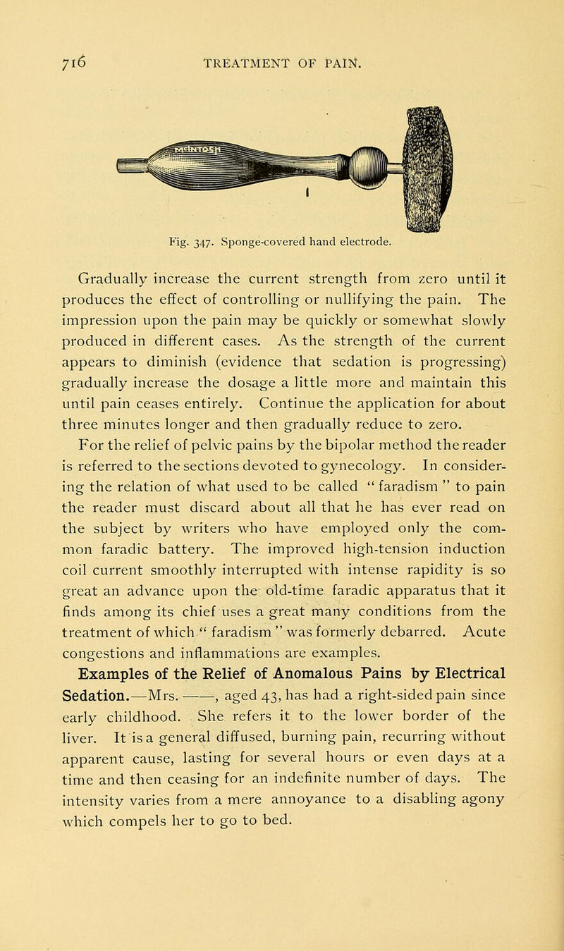 Fig. 347. Sponge-covered hand electrode. Gradually increase the current strength from zero until it produces the effect of controlling or nullifying the pain. The impression upon the pain may be quickly or somewhat slowly produced in different cases. As the strength of the current appears to diminish (evidence that sedation is progressing) gradually increase the dosage a little more and maintain this until pain ceases entirely. Continue the application for about three minutes longer and then gradually reduce to zero. For the relief of pelvic pains by the bipolar method the reader is referred to the sections devoted to gynecology. In consider- ing the relation of what used to be called  faradism  to pain the reader must discard about all that he has ever read on the subject by writers who have employed only the com- mon faradic battery. The improved high-tension induction coil current smoothly interrupted with intense rapidity is so great an advance upon the' old-time faradic apparatus that it finds among its chief uses a great many conditions from the treatment of which faradism  was formerly debarred. Acute congestions and inflammations are examples. Examples of the Relief of Anomalous Pains by Electrical Sedation.—Mrs. , aged 43, has had a right-sided pain since early childhood. She refers it to the lower border of the liver. It is a general diffused, burning pain, recurring without apparent cause, lasting for several hours or even days at a time and then ceasing for an indefinite number of days. The intensity varies from a mere annoyance to a disabling agony which compels her to go to bed.