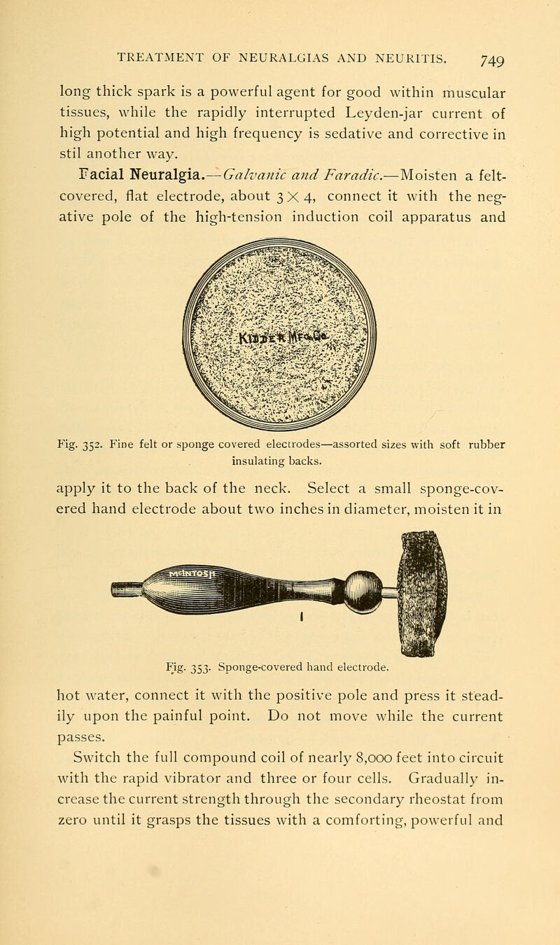 long thick spark is a powerful agent for good within muscular tissues, while the rapidly interrupted Leyden-jar current of high potential and high frequency is sedative and corrective in stil another way. Facial Neuralgia.—Galvanic and Faradic.—Moisten a felt- covered, flat electrode, about 3X4, connect it with the neg- ative pole of the high-tension induction coil apparatus and Fig. 352. Fine felt or sponge covered electrodes—assorted sizes with soft rubber insulating backs. apply it to the back of the neck. Select a small sponge-cov- ered hand electrode about two inches in diameter, moisten it in Fig. 353. Sponge-covered hand electrode. hot water, connect it with the positive pole and press it stead- ily upon the painful point. Do not move while the current passes. Switch the full compound coil of nearly 8,000 feet into circuit with the rapid vibrator and three or four cells. Gradually in- crease the current strength through the secondary rheostat from zero until it grasps the tissues with a comforting, powerful and