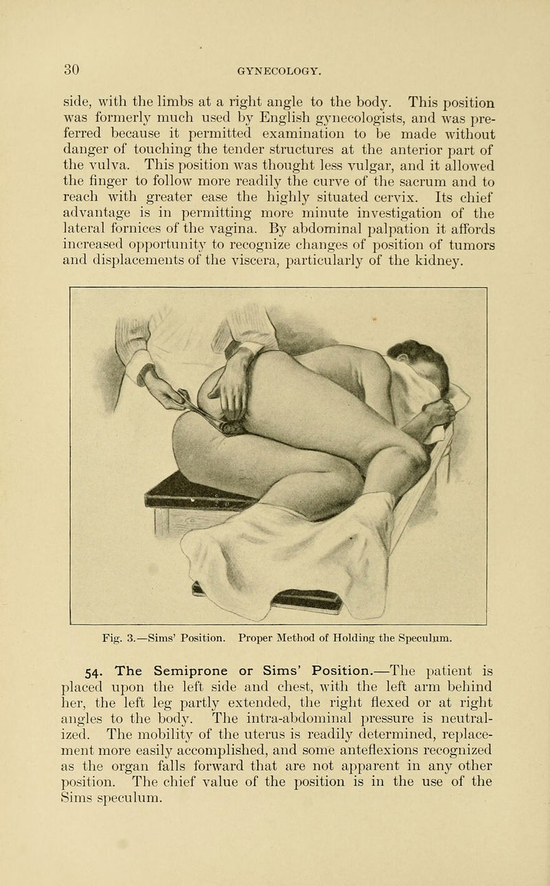 side, with the limbs at a right angle to the body. This position was formerly much used by English gynecologists, and was pre- ferred because it permitted examination to be made without danger of touching the tender structures at the anterior part of the vulva. This position was thought less vulgar, and it allowed the finger to follow more readily the curve of the sacrum and to reach with greater ease the highly situated cervix. Its chief advantage is in permitting more minute investigation of the lateral fornices of the vagina. By abdominal palpation it affords increased opportunity to recognize changes of position of tumors and displacements of the viscera, particularly of the kidney. Fig. 3.—Sims' Position. Proper Method of Holding the Speculum. 54. The Semiprone or Sims' Position.—The patient is placed upon the left side and chest, with the left arm behind her, the left leg partly extended, the right flexed or at right angles to the body. The intra-abdominal pressure is neutral- ized. The mobility of the uterus is readily determined, replace- ment more easily accomplished, and some anteflexions recognized as the organ falls forward that are not apparent in any other position. The chief value of the position is in the use of the Sims speculum.