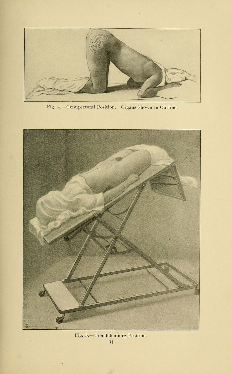 Fig. 4.—Genupectoral Position. Organs Shown in Outline. Fig. 5.—Trendelenburg Position.
