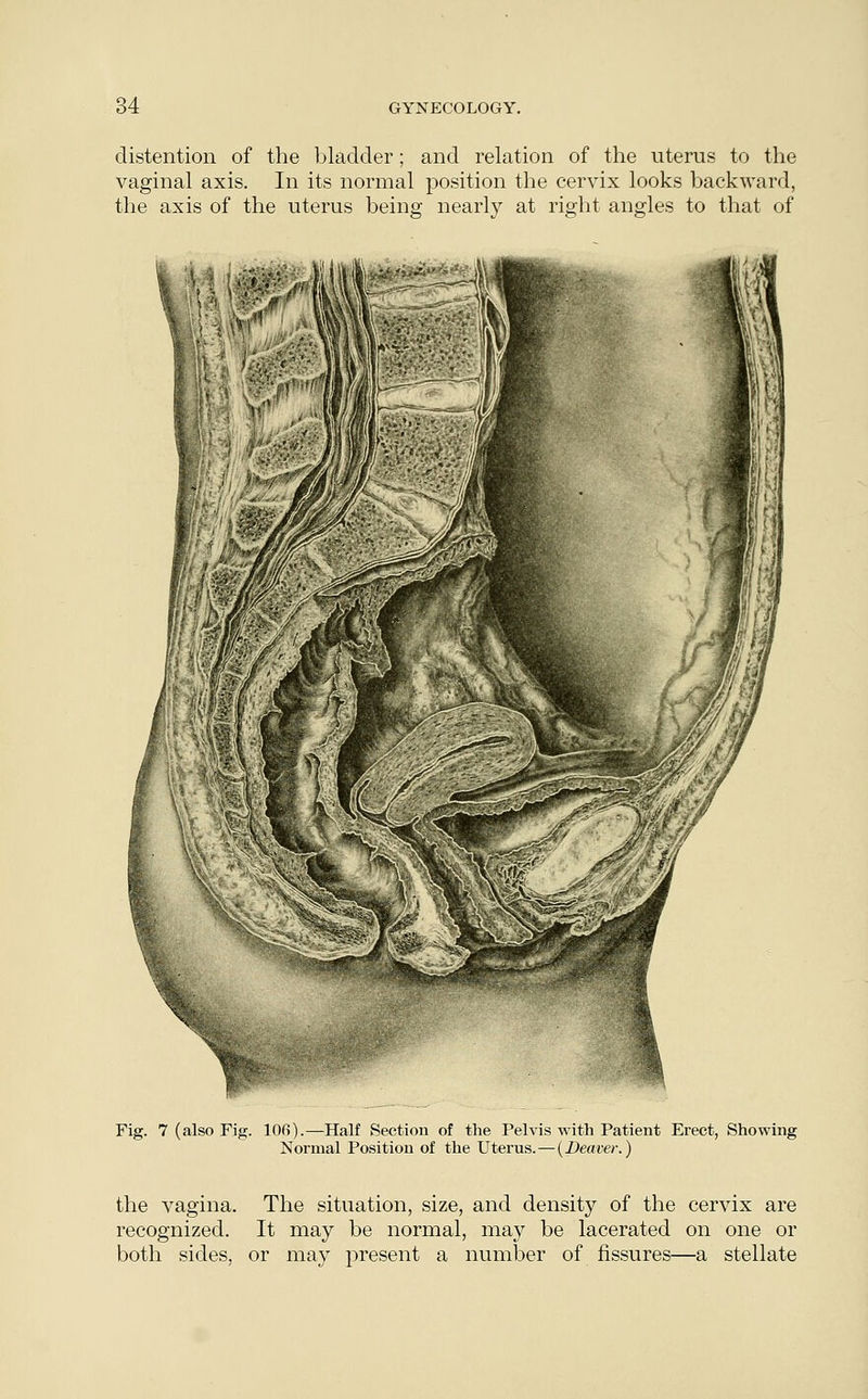 distention of the bladder; and relation of the uterus to the vaginal axis. In its normal position the cervix looks backward, the axis of the uterus being nearly at right angles to that of Fig. 7 (also Fig. 10fi).—Half Section of the Pelvis with Patient Erect, Showing Normal Position of the Uterus.—(Deaver.) the vagina. The situation, size, and density of the cervix are recognized. It may be normal, may be lacerated on one or both sides, or may present a number of fissures—a stellate