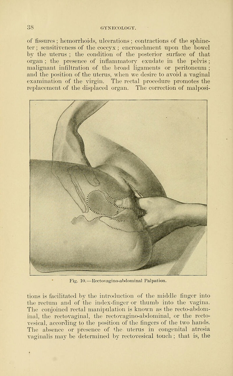of fissures ; hemorrhoids, ulcerations; contractions of the sphinc- ter ; sensitiveness of the coccyx; encroachment upon the bowel by the uterus ; the condition of the posterior surface of that organ ; the presence of inflammatory exudate in the pelvis ; malignant infiltration of the broad ligaments or peritoneum ; and the position of the uterus, when we desire to avoid a vaginal examination of the virgin. The rectal procedure promotes the replacement of the displaced organ. The correction of malposi- Fig. 10.—Rectovagino-abdominal Palpation. tions is facilitated by the introduction of the middle finger into the rectum and of the index-finger or thumb into the vagina. The conjoined rectal manipulation is known as the recto-abdom- inal, the rectovaginal, the rectovagino-abdominal, or the recto- vesical, according to the position of the fingers of the two hands. The absence or presence of the uterus in congenital atresia vaginalis may be determined by rectovesical touch ; that is, the