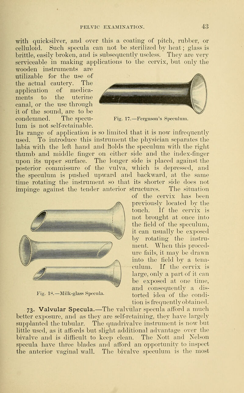 Fig. 17.—Ferguson's Speculum. with quicksilver, and over this a coating of pitch, rubber, or celluloid. Such specula can not be sterilized by heat; glass is brittle, easily broken, and is subsequently useless. They are very serviceable in making applications to the cervix, but only the wooden instruments are utilizable for the use of the actual cautery. The application of medica- ments to the uterine canal, or the use through it of the sound, are to be condemned. The specu- lum is not self-retainable. Its range of application is so limited that it is now infrequently used. To introduce this instrument the physician separates the labia with the left hand and holds the speculum with the right thumb and middle finger on either side and the index-finger upon its upper surface. The longer side is placed against the posterior commissure of the vulva, which is depressed, and the speculum is pushed upward and backward, at the same time rotating the instrument so that its shorter side does not impinge against the tender anterior structures. The situation of the cervix has been previously located by the touch. If the cervix is not brought at once into the field of the speculum, it can usually be exposed by rotating the instru- ment. When this proced- ure fails, it may be drawn into the field by a tena- culum. If the cervix is large, only a part of it can be exposed at one time, and consequently a dis- torted idea of the condi- tion is frequently obtained. 73. Valvular Specula.—The valvular specula afford a much better exposure, and as they are self-retaining, they have largely supplanted the tubular. The quadrivalve instrument is now but little used, as it affords but slight additional advantage over the bivalve and is difficult to keep clean. The Nott and Nelson specula have three blades and afford an opportunity to inspect the anterior vaginal wall. The bivalve speculum is the most Fig. 18.—Milk-glass Specula.
