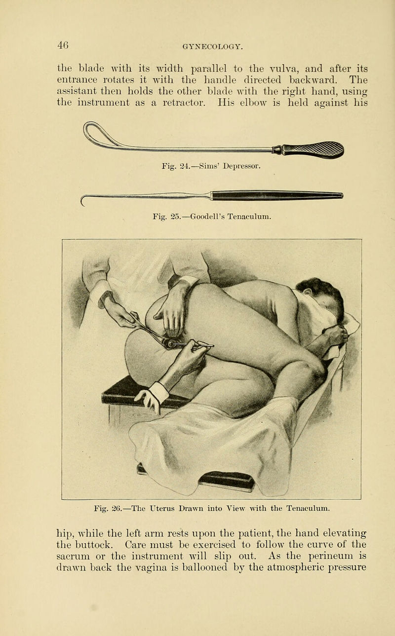 the blade with its width parallel to the vulva, and after its entrance rotates it with the handle directed backward. The assistant then holds the other blade with the right hand, using the instrument as a retractor. His elbow is held against his Fig. 24.—Sims' Depressor. Fig. 25.—Goodell's Tenaculum. Fig. 26.—The Uterus Drawn into View with the Tenaculum. hip, while the left arm rests upon the patient, the hand elevating the buttock. Care must be exercised to follow the curve of the sacrum or the instrument will slip out. As the perineum is drawn back the vagina is ballooned by the atmospheric pressure