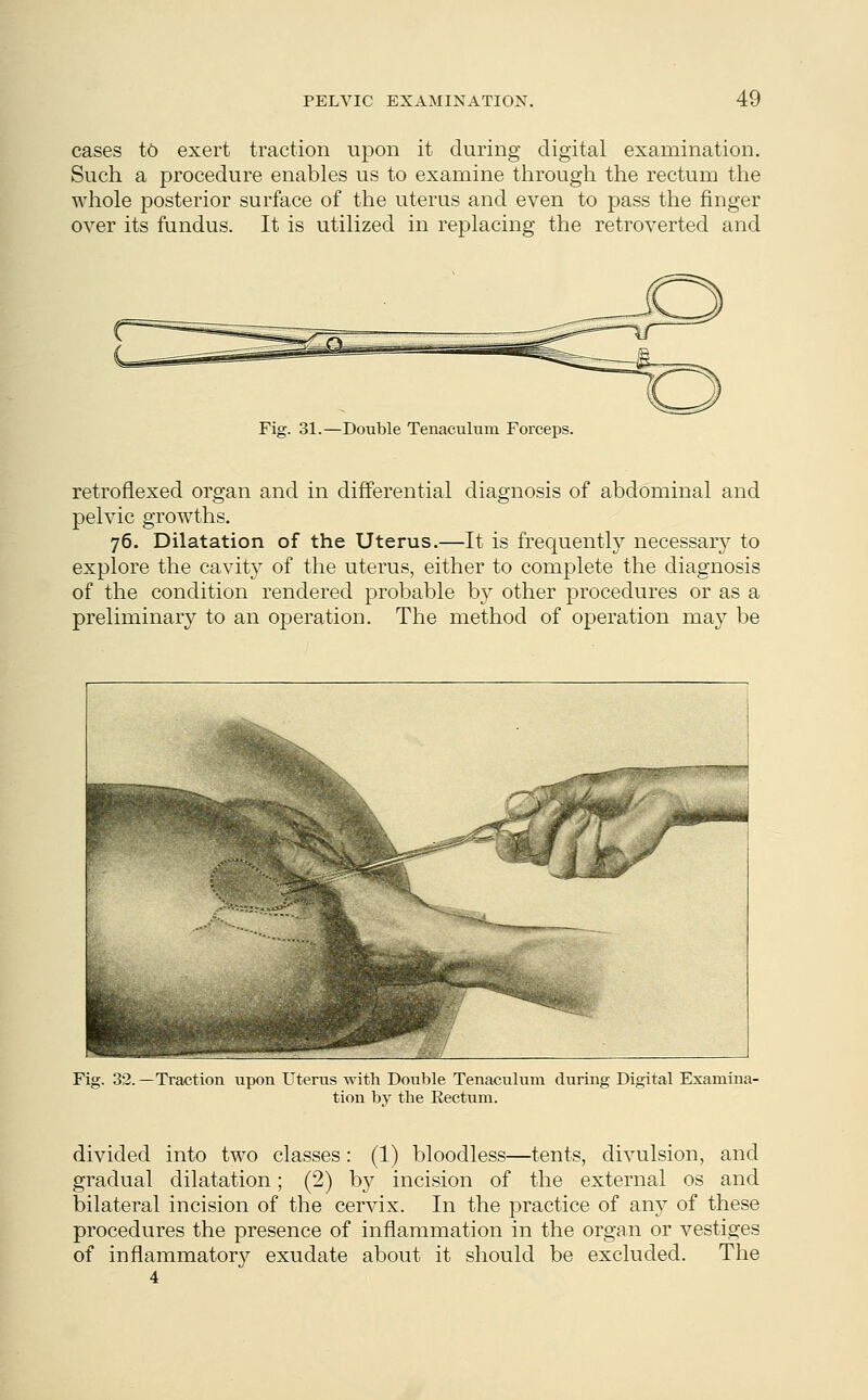 cases to exert traction upon it during digital examination. Such a procedure enables us to examine through the rectum the whole posterior surface of the uterus and even to pass the finger over its fundus. It is utilized in replacing the retroverted and Fig. 31.—Double Tenaculum Forceps. retroflexed organ and in differential diagnosis of abdominal and pelvic growths. 76. Dilatation of the Uterus.—It is frequently necessary to explore the cavity of the uterus, either to complete the diagnosis of the condition rendered probable by other procedures or as a preliminary to an operation. The method of operation may be Fig. 32.—Traction upon Uterus with Double Tenaculum during Digital Examina- tion by the Rectum. divided into two classes: (1) bloodless—tents, divulsion, and gradual dilatation; (2) by incision of the external os and bilateral incision of the cervix. In the practice of any of these procedures the presence of inflammation in the organ or vestiges of inflammatory exudate about it should be excluded. The 4