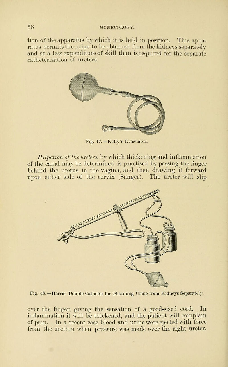 tion of the apparatus by which it is held in position. This appa- ratus permits the urine to be obtained from the kidneys separately and at a less expenditure of skill than is required for the separate catheterization of ureters. Fig. 47.—Kelly's Evacuator. Palpation of the ureters, by which thickening and inflammation of the canal may be determined, is practised by passing the finger behind the uterus in the vagina, and then drawing it forward upon either side of the cervix (Sanger). The ureter will slip Fig. 48.—Harris' Double Catheter for Obtaining Urine from Kidneys Separately. over the finger, giving the sensation of a good-sized cord. In inflammation it will be thickened, and the patient will complain of pain. In a recent case blood and urine were ejected with force from the urethra when pressure was made over the right ureter.