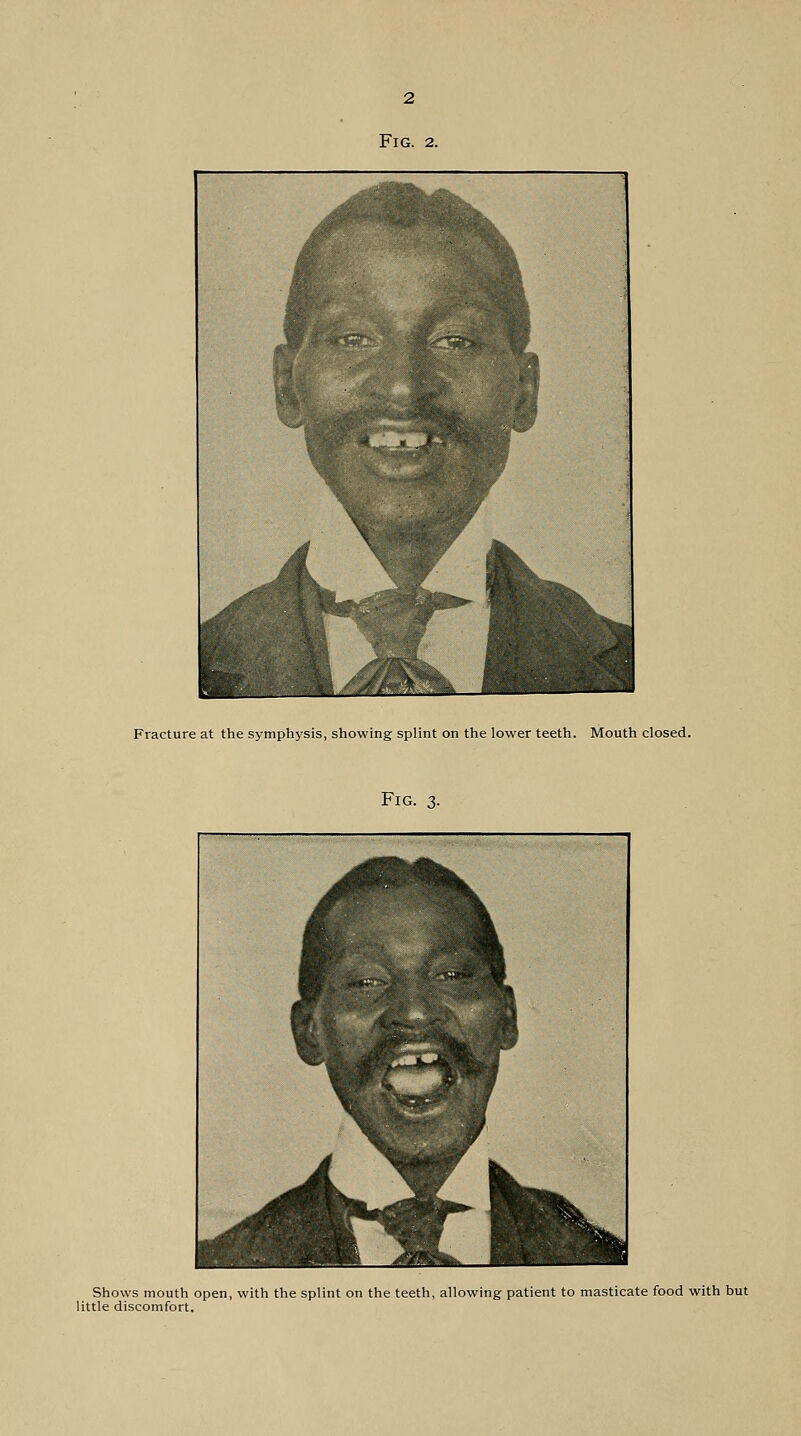 Fig. 2. Fracture at the symphysis, showing splint on the lower teeth. Mouth closed. Fig. 3. Shows mouth open, with the splint on the teeth, allowing patient to masticate food with but little discomfort.