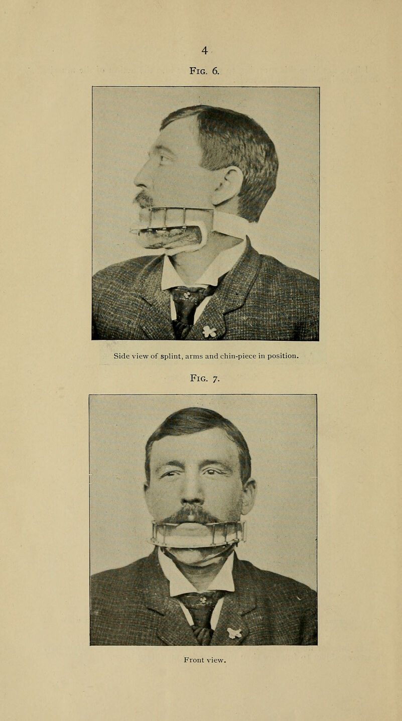 Fig. 6. Side view of splint, arms and chin-piece in position. Fig. 7. Front view.