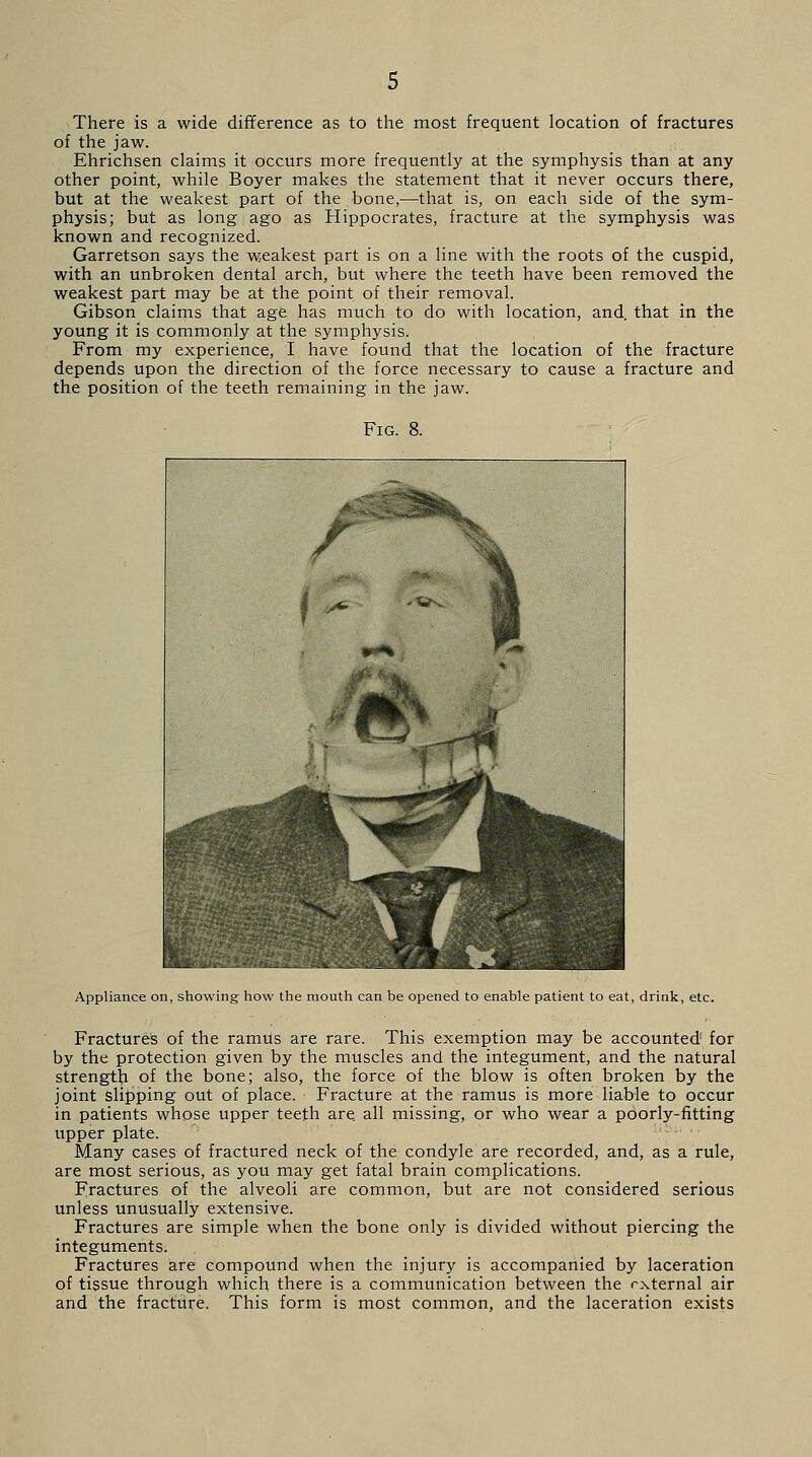 There is a wide difference as to the most frequent location of fractures of the jaw. Ehrichsen claims it occurs more frequently at the symphysis than at any other point, while Boyer makes the statement that it never occurs there, but at the weakest part of the bone,—that is, on each side of the sym- physis; but as long ago as Hippocrates, fracture at the symphysis was known and recognized. Garretson says the weakest part is on a line with the roots of the cuspid, with an unbroken dental arch, but where the teeth have been removed the weakest part may be at the point of their removal. Gibson claims that age has much to do with location, and, that in the young it is commonly at the symphysis. From my experience, I have found that the location of the fracture depends upon the direction of the force necessary to cause a fracture and the position of the teeth remaining in the jaw. Fig. 8. Appliance on, showing how the mouth can be opened to enable patient to eat, drink, etc. Fractures of the ramus are rare. This exemption may be accounted for by the protection given by the muscles and the integument, and the natural strength of the bone; also, the force of the blow is often broken by the joint slipping out of place. Fracture at the ramus is more liable to occur in patients whose upper teeth are. all missing, or who wear a poorly-fitting upper plate. Many cases of fractured neck of the condyle are recorded, and, as a rule, are most serious, as you may get fatal brain complications. Fractures of the alveoli are common, but are not considered serious unless unusually extensive. Fractures are simple when the bone only is divided without piercing the integuments. Fractures are compound when the injury is accompanied by laceration of tissue through which there is a communication between the rxternal air and the fracture. This form is most common, and the laceration exists