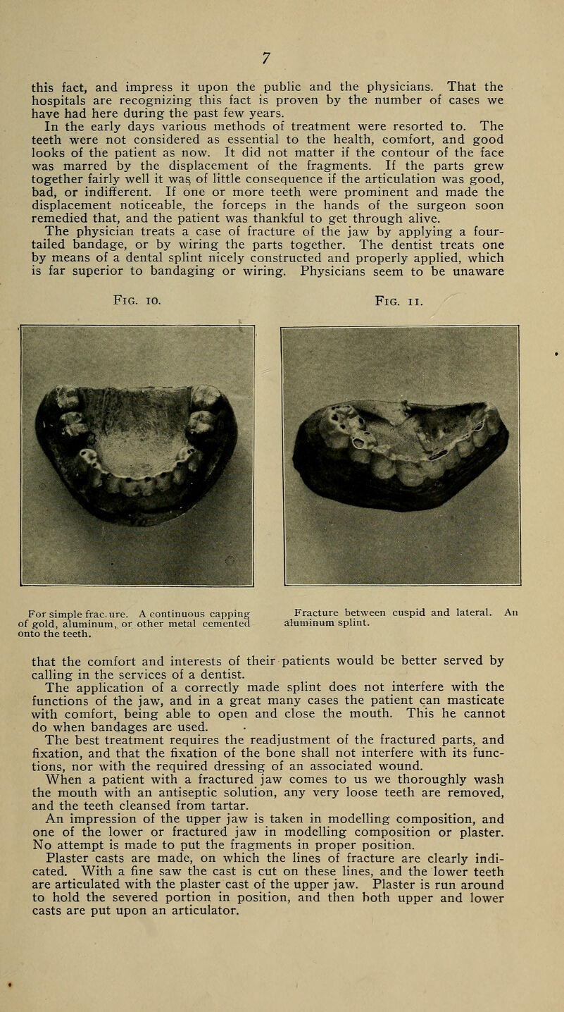 this fact, and impress it upon the public and the physicians. That the hospitals are recognizing this fact is proven by the number of cases we have had here during the past few years. In the early days various methods of treatment were resorted to. The teeth were not considered as essential to the health, comfort, and good looks of the patient as now. It did not matter if the contour of the face was marred by the displacement of the fragments. If the parts grew together fairly well it was, of little consequence if the articulation was good, bad, or indifferent. If one or more teeth were prominent and made the displacement noticeable, the forceps in the hands of the surgeon soon remedied that, and the patient was thankful to get through alive. The physician treats a case of fracture of the jaw by applying a four- tailed bandage, or by wiring the parts together. The dentist treats one by means of a dental splint nicely constructed and properly applied, which is far superior to bandaging or wiring. Physicians seem to be unaware Fig. io. Fig. ii. For simple frac.ure. A continuous capping of gold, aluminum, or other metal cemented onto the teeth. Fracture between cuspid and lateral, aluminum splint. that the comfort and interests of their patients would be better served by calling in the services of a dentist. The application of a correctly made splint does not interfere with the functions of the jaw, and in a great many cases the patient can masticate with comfort, being able to open and close the mouth. This he cannot do when bandages are used. The best treatment requires the readjustment of the fractured parts, and fixation, and that the fixation of the bone shall not interfere with its func- tions, nor with the required dressing of an associated wound. When a patient with a fractured jaw comes to us we thoroughly wash the mouth with an antiseptic solution, any very loose teeth are removed, and the teeth cleansed from tartar. An impression of the upper jaw is taken in modelling composition, and one of the lower or fractured jaw in modelling composition or plaster. No attempt is made to put the fragments in proper position. Plaster casts are made, on which the lines of fracture are clearly indi- cated. With a fine saw the cast is cut on these lines, and the lower teeth are articulated with the plaster cast of the upper jaw. Plaster is run around to hold the severed portion in position, and then both upper and lower casts are put upon an articulator.