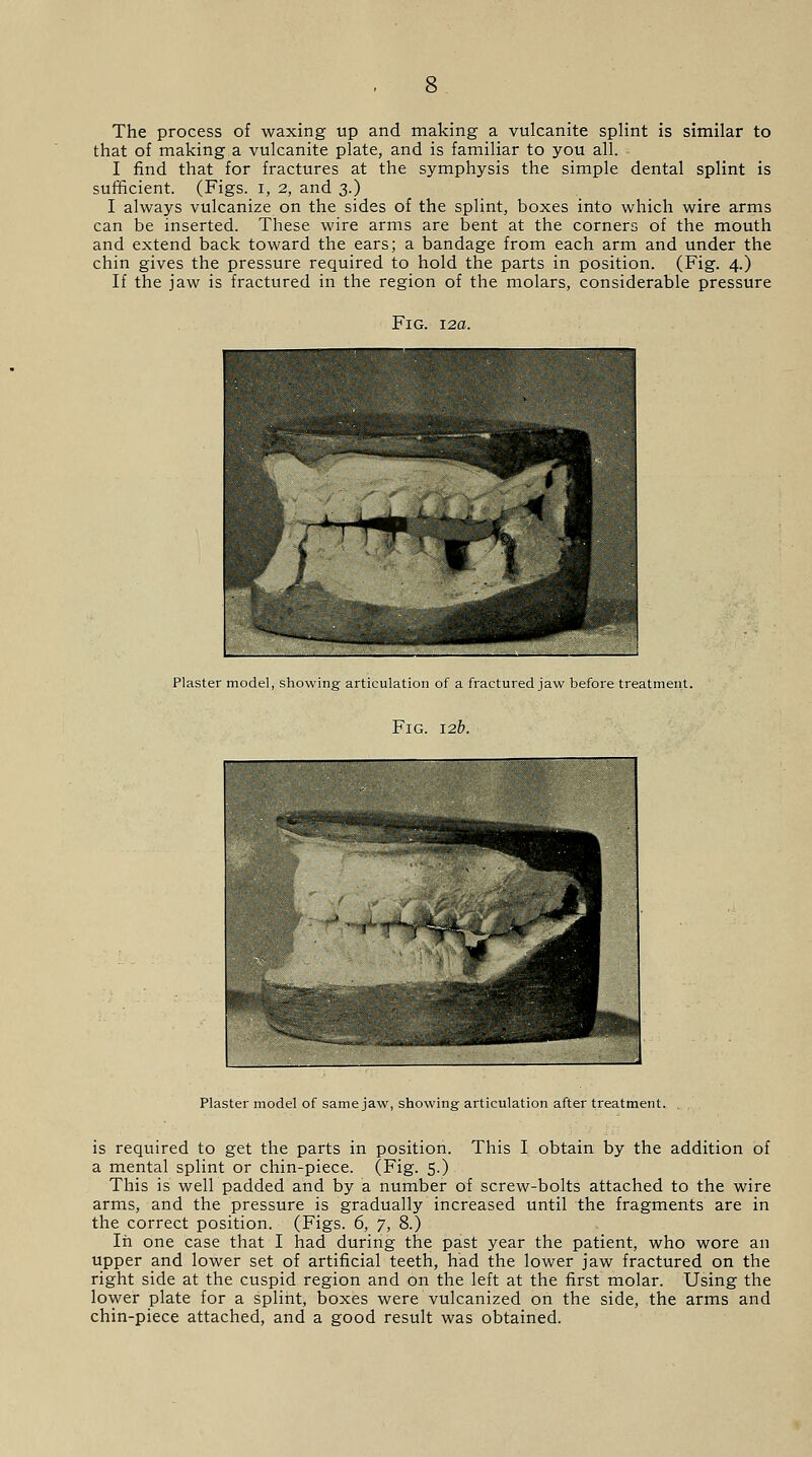 The process of waxing up and making a vulcanite splint is similar to that of making a vulcanite plate, and is familiar to you all. I find that for fractures at the symphysis the simple dental splint is sufficient. (Figs, i, 2, and 3.) I always vulcanize on the sides of the splint, boxes into which wire arms can be inserted. These wire arms are bent at the corners of the mouth and extend back toward the ears; a bandage from each arm and under the chin gives the pressure required to hold the parts in position. (Fig. 4.) If the jaw is fractured in the region of the molars, considerable pressure Fig. 12a. Plaster model, showing articulation of a fractured jaw before treatment. Fig. 12b. Plaster model of same jaw, showing articulation after treatment. . is required to get the parts in position. This I obtain by the addition of a mental splint or chin-piece. (Fig. 5.) This is well padded and by a number of screw-bolts attached to the wire arms, and the pressure is gradually increased until the fragments are in the correct position. (Figs. 6, 7, 8.) In one case that I had during the past year the patient, who wore an upper and lower set of artificial teeth, had the lower jaw fractured on the right side at the cuspid region and on the left at the first molar. Using the lower plate for a splint, boxes were vulcanized on the side, the arms and chin-piece attached, and a good result was obtained.