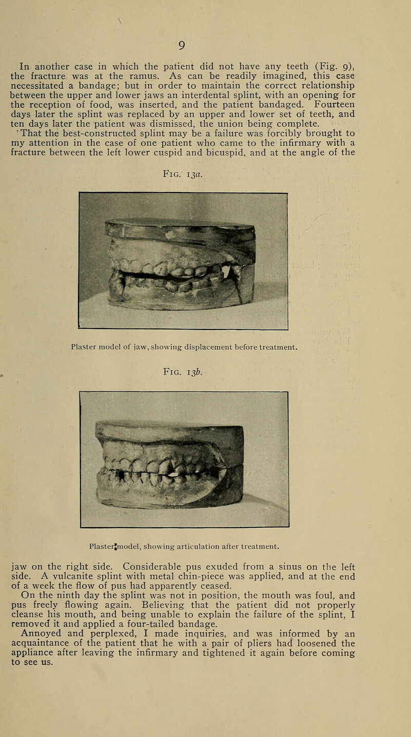 the fracture was at the ramus. As can be readily imagined, this case necessitated a bandage; but in order to maintain the correct relationship between the upper and lower jaws an interdental splint, with an opening for the reception of food, was inserted, and the patient bandaged. Fourteen days later the splint was replaced by an upper and lower set of teeth, and ten days later the patient was dismissed, the union being complete. ' That the best-constructed splint may be a failure was forcibly brought to my attention in the case of one patient who came to the infirmary with a fracture between the left lower cuspid and bicuspid, and at the angle of the Fig. 13a. Plaster model of jaw, showing displacement before treatment. Fig. 13b. Plasterjmodel, showing articulation after treatment. jaw on the right side. Considerable pus exuded from a sinus on the left side. A vulcanite splint with metal chin-piece was applied, and at the end of a week the flow of pus had apparently ceased. On the ninth day the splint was not in position, the mouth was foul, and pus freely flowing again. Believing that the patient did not properly cleanse his mouth, and being unable to explain the failure of the splint, I removed it and applied a four-tailed bandage. Annoyed and perplexed, I made inquiries, and was informed by an acquaintance of the patient that he with a pair of pliers had loosened the appliance after leaving the infirmary and tightened it again before coming to see us.