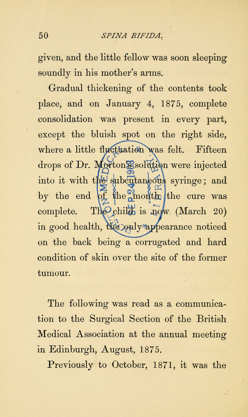 given, and the little fellow was soon sleeping soundly in his mother's arms. Gradual thickening of the contents took place, and on January 4, 1875, complete consolidation was present in every part, except the bluish spot on the right side, where a little ni^%ati^nVas felt. Fifteen drops of Dr. M^ton§solution were injected into it with thW slubcutan&dus syringe; and by the end pf the QmontfaQ jthe cure was complete. TBe-^phil^B is *n*w (March 20) in good health, rSfcofily^appearance noticed on the back being a corrugated and hard condition of skin over the site of the former tumour. The following was read as a communica- tion to the Surgical Section of the British Medical Association at the annual meeting in Edinburgh, August, 1875. Previously to October, 1871, it was the