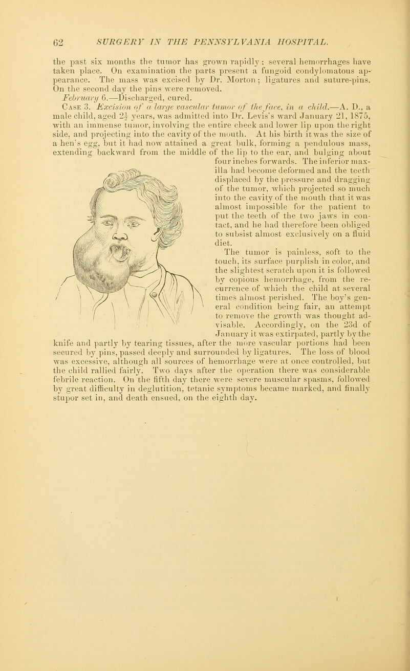 the past six months the tumor has grown rapidly ; several hemorrhages have taken place. On examination the parts present a fungoid condylomatous ap- pearance. The mass was excised by Dr. Morton ; ligatures and suture-pins. On the second day the pins were removed. February 6.—Discharged, cured. Case 3. Excision of a large vascular tumor of the face, in a child.—A. D., a male child, aged 1\ years, was admitted into Dr. Levis's ward January 21, 1875, with an immense tumor, involving the entire cheek and lower lip upon the right side, and projecting into the cavity of the mouth. At his birth it was the size of a hen's egg, but it had now attained a great bulk, forming a pendulous mass, extending backward from the middle of the lip to the ear, and bulging about four inches forwards. The inferior max- —-cv^, ilia had become deformed and the teeth , ' displaced by the pressure and dragging of the tumor, which projected so much into the cavity of the mouth that it was almost impossible for the patient to put the teeth of the two jaws in con- tact, and he had therefore been obliged to subsist almost exclusively on a fluid diet. The tumor is painless, soft to the touch, its surface purplish in color, and the slightest scratch upon it is followed by copious hemorrhage, from the re- currence of which the child at several times almost perished. The boy's gen- eral condition being fair, an attempt to remove the growth Avas thought ad- visable. Accordingly, on the 23d of January it was extirpated, partly by the knife and partly by tearing tissues, after the more vascular portions had been secured by pins, passed deeply and surrounded by ligatures. The loss of blood was excessive, although all sources of hemorrhage were at once controlled, but the child rallied fairly. Two days after the operation there was considerable febrile reaction. On the fifth day there were severe muscular spasms, followed by great difficulty in deglutition, tetanic symptoms became marked, and finally stupor set in, and death ensued, on the eighth day. \ I
