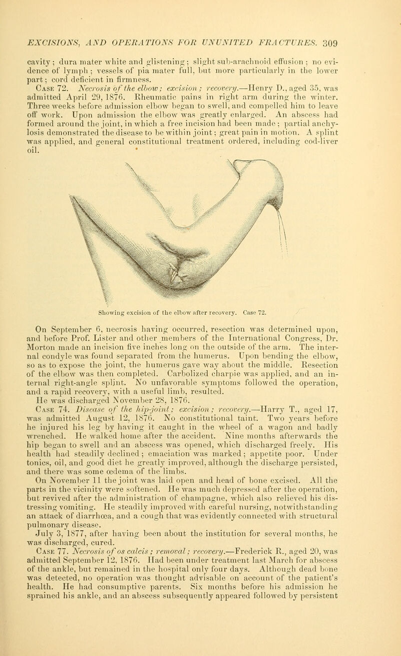 cavity; dura mater white and glistening; slight sub-arachnoid effusion ; no evi- dence of lymph ; vessels of pia mater full, hut more particularly in the lower part; cord deficient in firmness. Case 72. Necrosis of the elbow; excision; recovery.—Henry D., aged 35, was admitted April 29, 1876. Rheumatic pains in right arm during the winter. Three weeks before admission elbow began to swell, and compelled him to leave off work. Upon admission the elbow was greatly enlarged. An abscess had formed around the joint, in which a free incision had been made ; partial anchy- losis demonstrated the disease to be within joint; great pain in motion. A splint was applied, and general constitutional treatment ordered, including cod-liver oil. Showing excision of the elbow after recovery. Case 72. On September 6, necrosis having occurred, resection was determined upon, and before Prof. Lister and other members of the International Congress, Dr. Morton made an incision five inches long on the outside of the arm. The inter- nal condyle was found separated from the humerus. Upon bending the elbow, so as to expose the joint, the humerus gave way about the middle. Resection of the elbow was then completed. Carbolized charpie was applied, and an in- ternal right-angle splint. No unfavorable symptoms followed the operation, and a rapid recovery, with a useful limb, resulted. He was discharged November 28, 1876. Case 74. Disease of the hip-joint; excision; recovery.—Harry T., aged 17, was admitted August 12, 1876. No constitutional taint. Two years before he injured his leg by having it caught in the wheel of a wagon and badly wrenched. He walked home after the accident. Nine months afterwards the hip began to swell and an abscess was opened, which discharged freely. His health had steadily declined; emaciation was marked; appetite poor. Under tonics, oil, and good diet he greatly improved, although the discharge persisted, and there was some oedema of the limbs. On November 11 the joint was laid open and head of bone excised. All the parts in the vicinity were softened. He was much depressed after the operation, but revived after the administration of champagne, which also relieved his dis- tressing vomiting. He steadily improved with careful nursing, notwithstanding an attack of diarrhoea, and a cough that was evidently connected with structural pulmonary disease. July 3, 1877, after having been about the institution for several months, he was discharged, cured. Case 77. Necrosis of os calcis; removal; recovery.—Frederick R., aged 20, was admitted September 12, 1876. Had been under treatment last March for abscess of the ankle, but remained in the hospital only four days. Although dead bone was detected, no operation was thought advisable on account of the patient's health. He had consumptive parents. Six months before his admission he sprained his ankle, and an abscess subsequently appeared followed by persistent