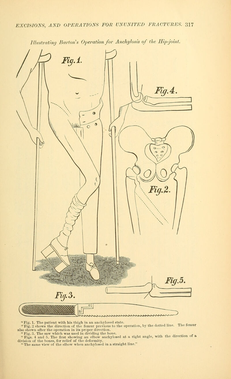 Illustrating Barton's Operation for Anchylosis of the Hip-joint. Fig. 1. The patient with his thigh in an anchylosed state. Fig. 2 shows the direction of the femur previous to the operation, by the dotted line. The femur also shown after the operation in its proper direction. Fig. 3. The saw which was used in dividing the bone. Figs. 4 and 5. The first showing an elbow anchylosed at a right angle, with the direction ot a division of the bones, for relief of the defoi-mity.  The same view of the elbow when anchylosed in a straight line.