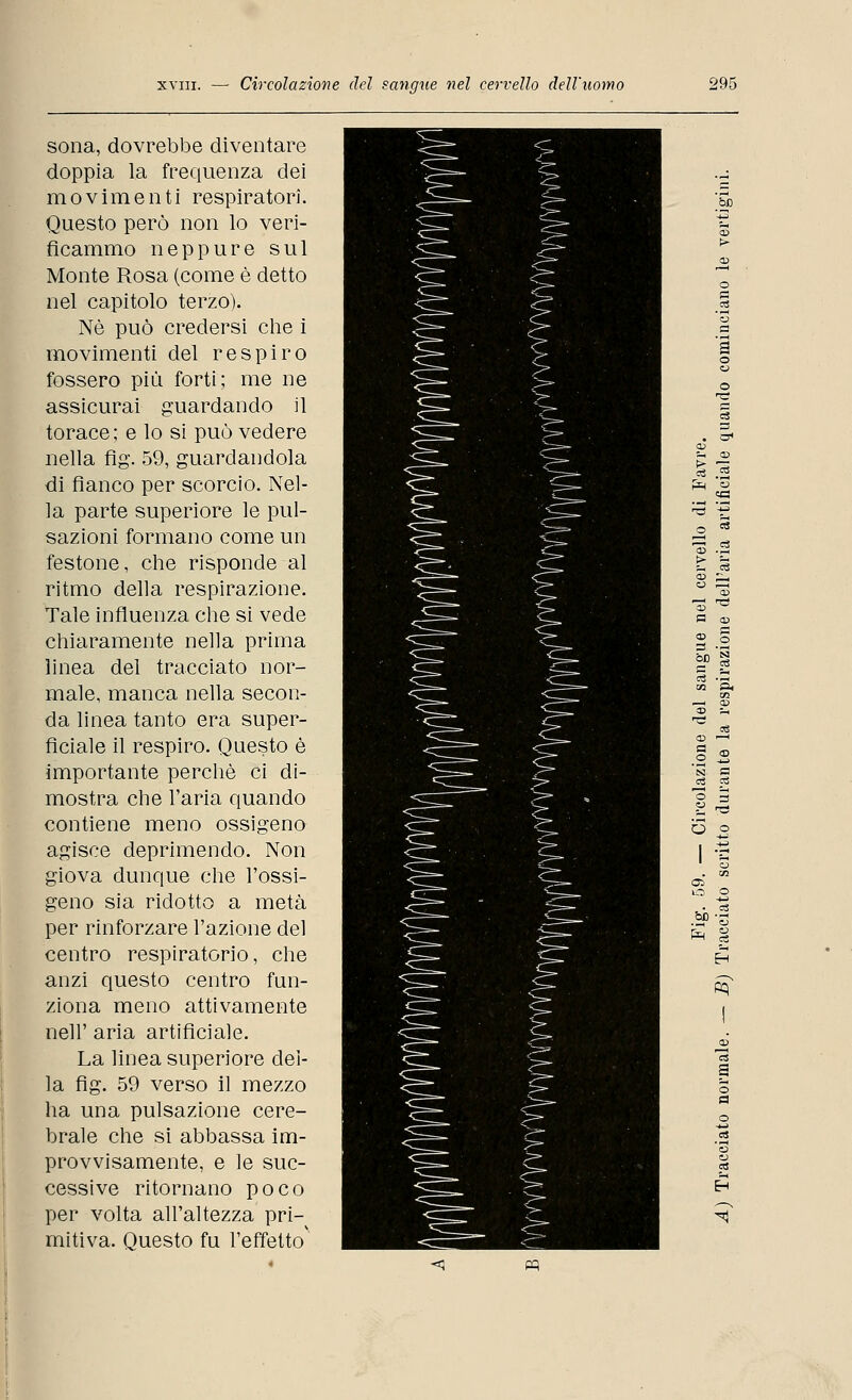 sona, dovrebbe diventare doppia la frequenza dei movimenti respiratori. Questo però non lo veri- ficammo neppure sul Monte Rosa (come è detto nel capitolo terzo). Né può credersi che i movimenti del respiro fossero più forti; me ne assicurai guardando il torace; e lo si può vedere nella fig. 59, guardandola di fianco per scorcio. Nel- la parte superiore le pul- sazioni formano come un festone, che risponde al ritmo della respirazione. Tale influenza che si vede chiaramente nella prima linea del tracciato nor- male, manca nella secon- da linea tanto era super- ficiale il respiro. Questo è importante perchè ci di- mostra che l'aria quando contiene meno ossigeno agisce deprimendo. Non giova dunque che l'ossi- geno sia ridotto a metà per rinforzare l'azione del centro respiratorio, che anzi questo centro fun- ziona meno attivamente neh' aria artificiale. La linea superiore dei- la fig. 59 verso il mezzo ha una pulsazione cere- brale che si abbassa im- provvisamente, e le suc- cessive ritornano poco per volta all'altezza pri- mitiva. Questo fu l'effetto' in H > ci .2 «C H=S n a ri > ctì <v O) v Tà a CO CD PS 3 OC N g 3 o o ■4-1 ; CJ ■n Ct IO © Cf, oc u fr Cfl PQ