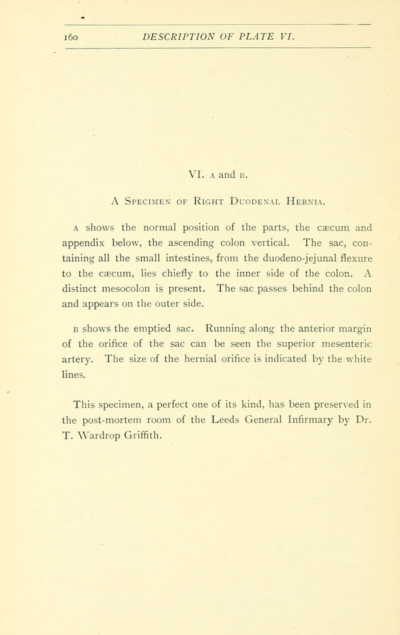 VI. A and B. A Specimen of Right Duodexal Herxia. A shows the normal position of the parts, the caecum and appendix below, the ascending colon vertical. The sac, con- taining all the small intestines, from the duodeno-jejunal flexure to the caecum, lies chiefly to the inner side of the colon. A distinct mesocolon is present. The sac passes behind the colon and appears on the outer side. B shows the emptied sac. Running along the anterior margin of the orifice of the sac can be seen the superior mesenteric artery. The size of the hernial orifice is indicated by the white lines. This specimen, a perfect one of its kind, has been preserved in the post-mortem room of the Leeds General Infirmary by Dr. T. Wardrop Griffith.