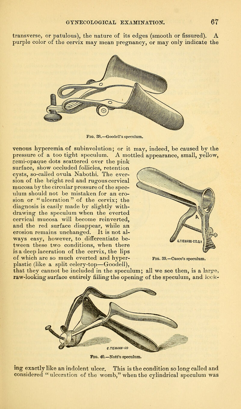 transverse, or patulous), the nature of its edges (smooth or fissured). A purple color of the cervix may mean pregnancy, or may only indicate the Fig. 88.—Goodeirs speculum. venous hyperemia of subinvolution; or it may, indeed, be caused by the pressure of a too tight speculum. A mottled appearance, small, yellow, Eemi-opaque dots scattered over the pink surface, show occluded follicles, retention cysts, so-called ovula Nabothi. The ever- sion of the bright red and rugous cervical m ucosa by the circular pressure of the spec- ulum should not be mistaken for an ero- sion or ulceration of the cervix; the diagnosis is easily made by slightly with- drawing the speculum when the everted cervical mucosa will become reinverted, and the red surface disappear, while an erosion remains unchanged. It is not al- ways easy, however, to differentiate be- tween these two conditions, when there is a deep laceration of the cervix, the lips of which are so much everted and hyper- plastic (like a split celery-top—Goodell), that they cannot be included in the speculum; all we see then, is a large, raw-looking surface entirely filling the opening of the speculum, and look- Fig. 39.—Cusco's speculum. e.TiEMAim-co Fig. 40.—Nott's speculum. ing exactly like an indolent ulcer. This is the condition so long called and considered  ulceration of the womb, when the cylindrical speculum was