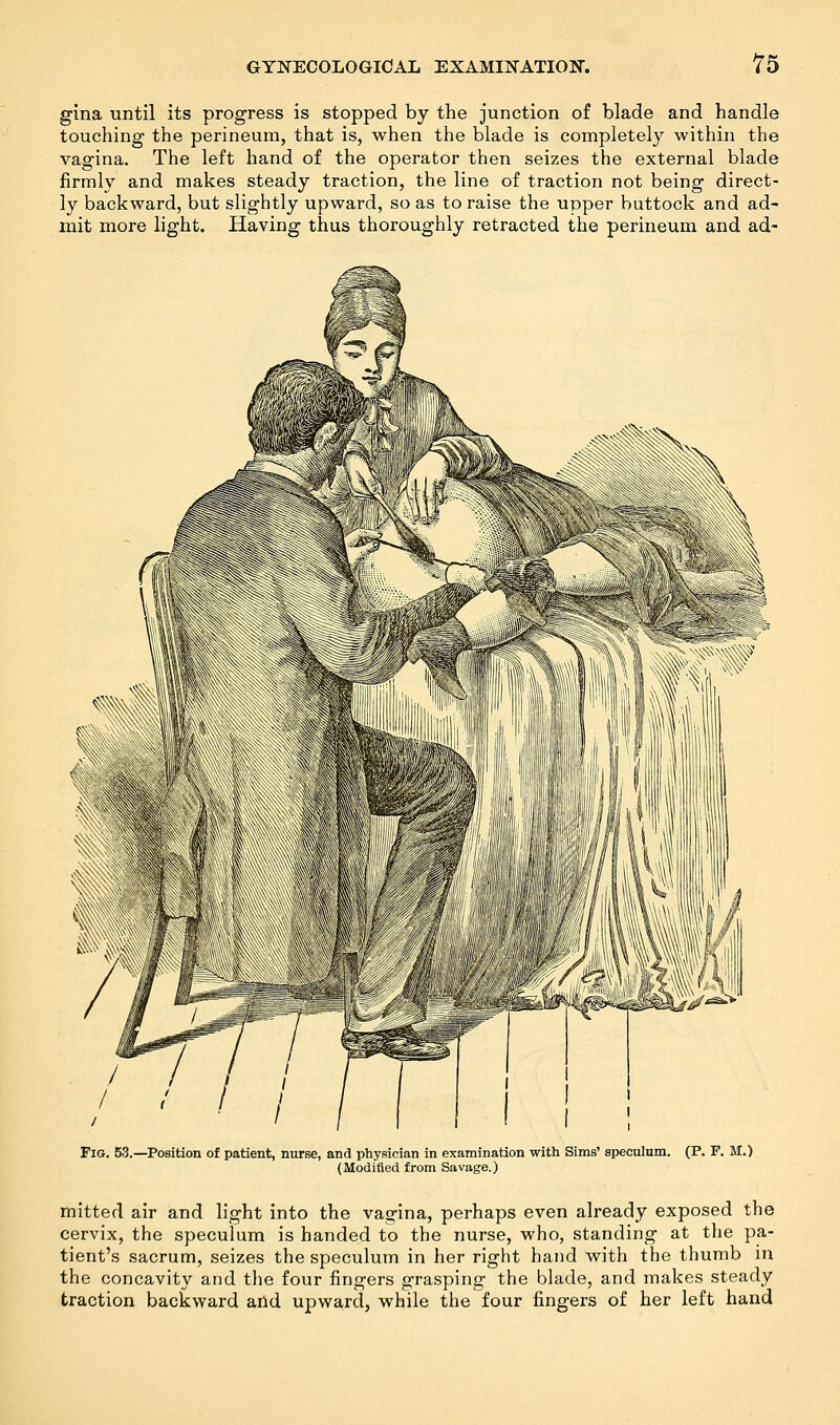 gina until its progress is stopped by the junction of blade and handle touching the perineum, that is, when the blade is completely within the vagina. The left hand of the operator then seizes the external blade firmly and makes steady traction, the line of traction not being direct- ly backward, but slightly upward, so as to raise the upper buttock and ad- mit more light. Having thus thoroughly retracted the perineum and ad- Fig. 53.—Position of patient, nurse, and physician in examination with Sims1 speculum. (P. F. M.) (Modified from Savage.) mitted air and light into the vagina, perhaps even already exposed the cervix, the speculum is handed to the nurse, who, standing at the pa- tient's sacrum, seizes the speculum in her right hand with the thumb in the concavity and the four fingers grasping the blade, and makes steady traction backward and upward, while the four fingers of her left hand