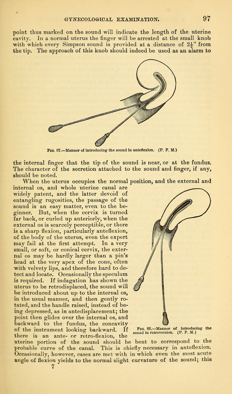 point thus marked on the sound will indicate the length of the uterine cavity. In a normal uterus the finger will be arrested at the small knob with which every Simpson sound is provided at a distance of 2£ from the tip. The approach of this knob should indeed be used as an alarm to Fib. 87.—Manner of introducing the sound In anteflexion. (P. F. M.) the internal finger that the tip of the sound is near, or at the fundus. The character of the secretion attached to the sound and finger, if any, should be noted. When the uterus occupies the normal position, and the external and internal os, and whole uterine canal are widely patent, and the latter devoid of entangling rugosities, the passage of the sound is an easy matter, even to the be- ginner. But, when the cervix is turned far back, or curled up anteriorly, when the external os is scarcely perceptible, or there is a sharp flexion, particularly anteflexion, of the body of the uterus, even the expert may fail at the first attempt. In a very small, or soft, or conical cervix, the exter- nal os may be hardly larger than a pin's head at the very apex of the cone, often with velvety lips, and therefore hard to de- tect and locate. Occasionally the speculum is required. If indagation has shown the uterus to be retrodisplaced, the sound will be introduced about up to the internal os, in the usual manner, and then gently ro- tated, and the handle raised, instead of be- ing depressed, as in antedisplacement; the point then glides over the internal os, and backward to the fundus, the concavity of the instrument looking backward. If there is an ante- or retro-flexion, the uterine portion of the sound should be bent to correspond to the probable curve of the canal. This is chiefly necessary in anteflexion. Occasionally, however, cases are met with in which even the most acute angle of flexion yields to the normal slight curvature of the sound; this 7 ■Manner of introducing the sound in retroversion. (P. F. M.)