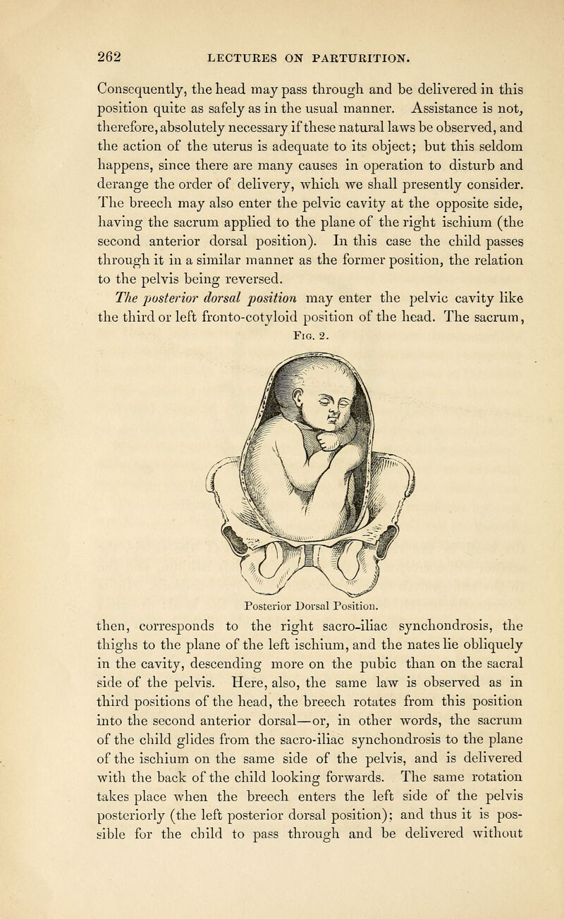 Consequently, the head may pass through and be delivered in this position quite as safely as in the usual manner. Assistance is not^ therefore, absolutely necessary if these natural laws be observed, and the action of the uterus is adequate to its object; but this seldom happens, since there are many causes in operation to disturb and derange the order of delivery, which we shall presently consider. The breech may also enter the pelvic cavity at the opposite side, havhig the sacrum applied to the plane of the right ischium (the second anterior dorsal position). In this case the child passes through it in a similar manner as the former position, the relation to the pelvis being reversed. The posterio?- dorsal position may enter the pelvic cavity like the third or left fronto-cotyloid position of the head. The sacrum, Fig. 2. Posterior Dorsal Position. then, corresponds to the right sacro-iliac synchondrosis, the thighs to the plane of the left ischium, and the nates lie obliquely in the cavity, descending more on the pubic than on the sacral side of the pelvis. Here, also, the same law is observed as in third positions of the head, the breech rotates from this position into the second anterior dorsal—or^ in other words, the sacrum of the child glides from the sacro-iliac synchondrosis to the plane of the ischium on the same side of the pelvis, and is delivered with the back of the child looking forwards. The same rotation takes place when the breech enters the left side of the pelvis posteriorly (the left posterior dorsal position); and thus it is pos- sible for the child to pass through and be delivered without