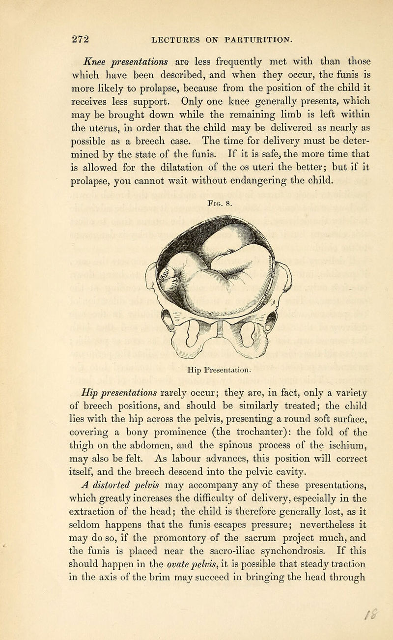 Knee presentations are less frequently met with than those which have been described, and when they occur, the funis is more likely to prolapse, because from the position of the child it receives less support. Only one knee generally presents, which may be brought down while the remaining limb is left within the uterus, in order that the child may be delivered as nearly as possible as a breech case. The time for delivery must be deter- mined by the state of the funis. If it is safe^ the more time that is allowed for the dilatation of the os uteri the better; but if it prolapse, you cannot wait without endangering the child. Fig. 8. Hip Presentation. Hip presentations rarely occur; they are, in fact, only a variety of breech positions, and should be similarly treated; the child lies with the hip across the pelvis, presenting a round soft surface, covering a bony prominence (the trochanter): the fold of the thigh on the abdomen, and the spinous process of the ischium, may also be felt. As labour advances, this position will correct itself, and the breech descend into the pelvic cavity. A distorted pelvis may accompany any of these presentations, which greatly increases the difficulty of delivery, especially in the extraction of the head; the child is therefore generally lost, as it seldom happens that the funis escapes pressure; nevertheless it may do so, if the promontory of the sacrum project much, and the funis is placed near the sacro-iliac synchondrosis. If this should happen in the ovate pelvis, it is possible that steady traction in the axis of the brim may succeed in bringing the head through /^