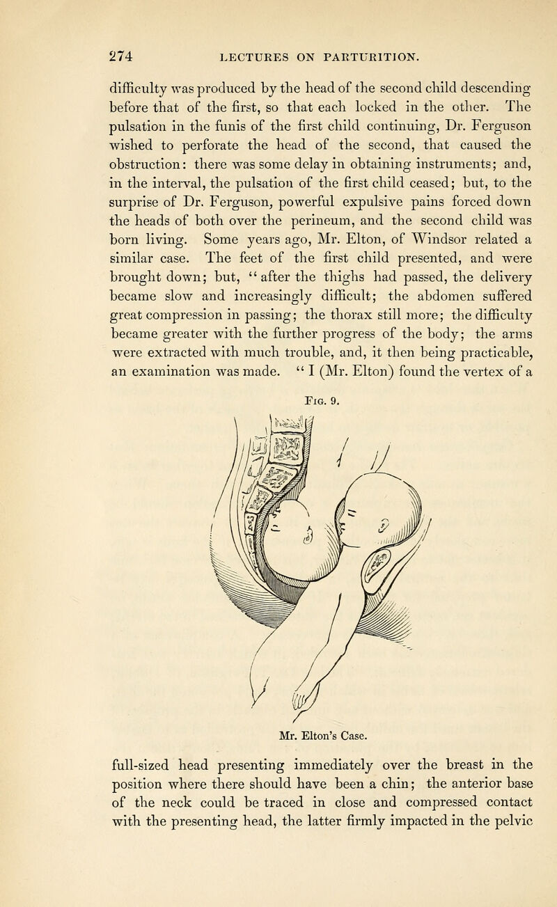 difficulty was produced by tlie liead of the second child descending before that of the first, so that each locked in the other. The pulsation in the funis of the first child continuing, Dr. Ferguson wished to perforate the head of the second, that caused the obstruction: there was some delay in obtaining instruments; and, in the interval, the pulsatio)i of the first child ceased; but, to the surprise of Dr. Ferguson, powerful expulsive pains forced down the heads of both over the perineum, and the second child was born living. Some years ago, Mr. Elton, of Windsor related a similar case. The feet of the first child presented, and were brought down; but,  after the thighs had passed, the delivery became slow and increasingly difficult; the abdomen suffered great compression in passing; the thorax still more; the difficulty became greater with the further progress of the body; the arms were extracted with much trouble, and, it then being practicable, an examination was made.  I (Mr. Elton) found the vertex of a Tig. 9. Mr. Elton's Case. full-sized head presenting immediately over the breast in the position where there should have been a chin; the anterior base of the neck could be traced in close and compressed contact with the presenting head, the latter firmly impacted in the pelvic