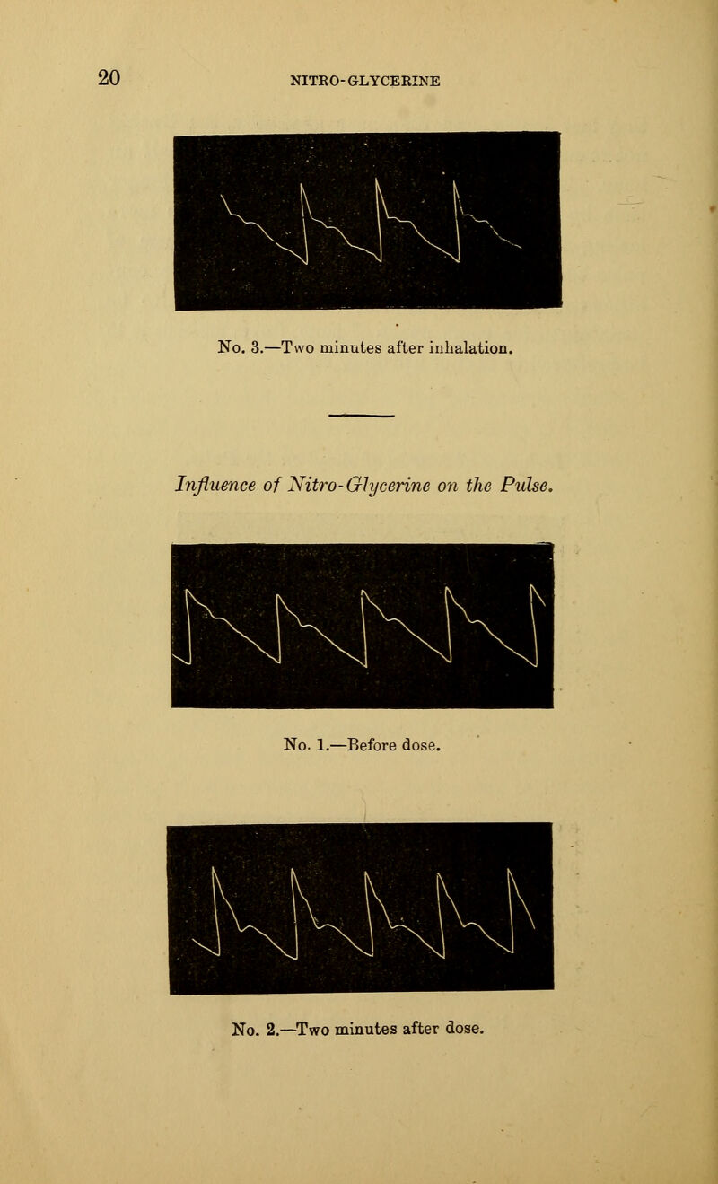 No. 3.—Two minutes after inhalation. Influence of Nitro-Glycerine on the Pulse. No. 1.—Before dose.