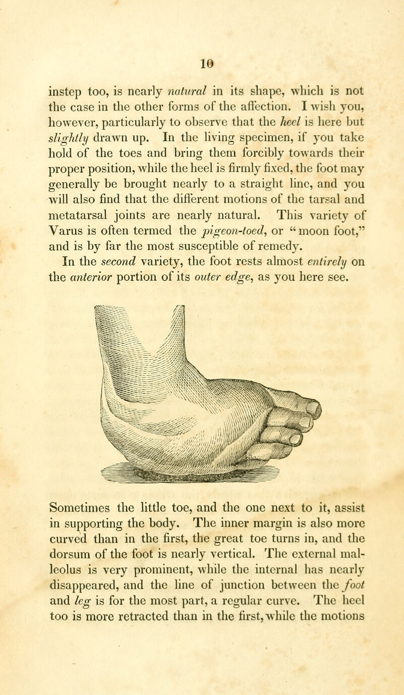 instep too, is nearly natural in its shape, which is not the case in the other forms of the affection. I wish you, however, particularly to observe that the heel is here but slightly drawn up. In the living specimen, if you take hold of the toes and bring them forcibly towards their proper position, while the heel is firmly fixed, the foot may generally be brought nearly to a straight line, and you will also find that the different motions of the tarsal and metatarsal joints are nearly natural. This variety of Varus is often termed the pigeon-toed, or  moon foot, and is by far the most susceptible of remedy. In the second variety, the foot rests almost entirely on the anterior portion of its outer edge, as you here see. Sometimes the little toe, and the one next to it, assist in supporting the body. The inner margin is also more curved than in the first, the great toe turns in, and the dorsum of the foot is nearly vertical. The external mal- leolus is very prominent, while the internal has nearly disappeared, and the line of junction between the foot and leg is for the most part, a regular curve. The heel too is more retracted than in the first, while the motions