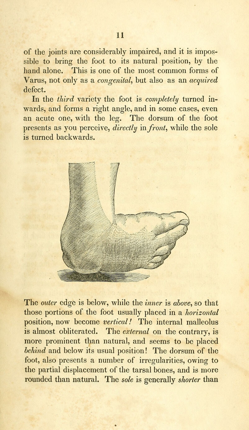 of the joints are considerably impaired, and it is impos- sible to bring the foot to its natural position, by the hand alone. This is one of the most common forms of Varus, not only as a congenital, but also as an acquired defect. In the third variety the foot is completely turned in- wards, and forms a right angle, and in some cases, even an acute one, with the leg. The dorsum of the foot presents as you perceive, directly in front, while the sole is turned backwards. The outer edge is below, while the inner is above, so that those portions of the foot usually placed in a horizontal position, now become vertical! The internal malleolus is almost obliterated. The external on the contrary, is more prominent than natural, and seems to be placed behind and below its usual position! The dorsum of the foot, also presents a number of irregularities, owing to the partial displacement of the tarsal bones, and is more rounded than natural. The sole is generally shorter than