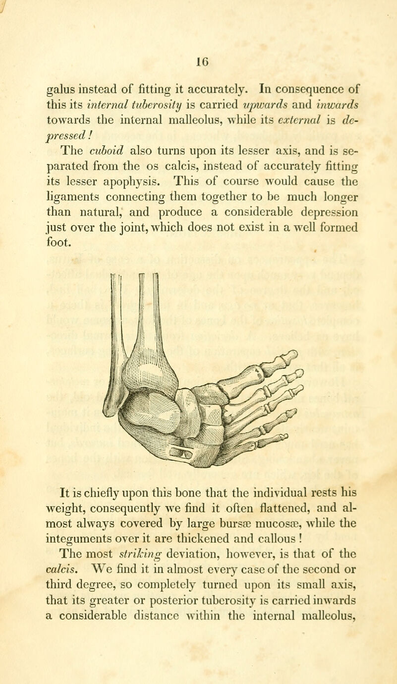 galus instead of fitting it accurately. In consequence of this its internal tuberosity is carried upwards and inwards towards the internal malleolus, while its external is de- pressed ! The cuboid also turns upon its lesser axis, and is se- parated from the os calcis, instead of accurately fitting its lesser apophysis. This of course would cause the ligaments connecting them together to be much longer than natural, and produce a considerable depression just over the joint, which does not exist in a well formed foot. It is chiefly upon this bone that the individual rests his weight, consequently we find it often flattened, and al- most always covered by large bursa? mucosa?, while the integuments over it are thickened and callous ! The most striking deviation, however, is that of the calcis. We find it in almost every case of the second or third degree, so completely turned upon its small axis, that its greater or posterior tuberosity is carried inwards a considerable distance within the internal malleolus,